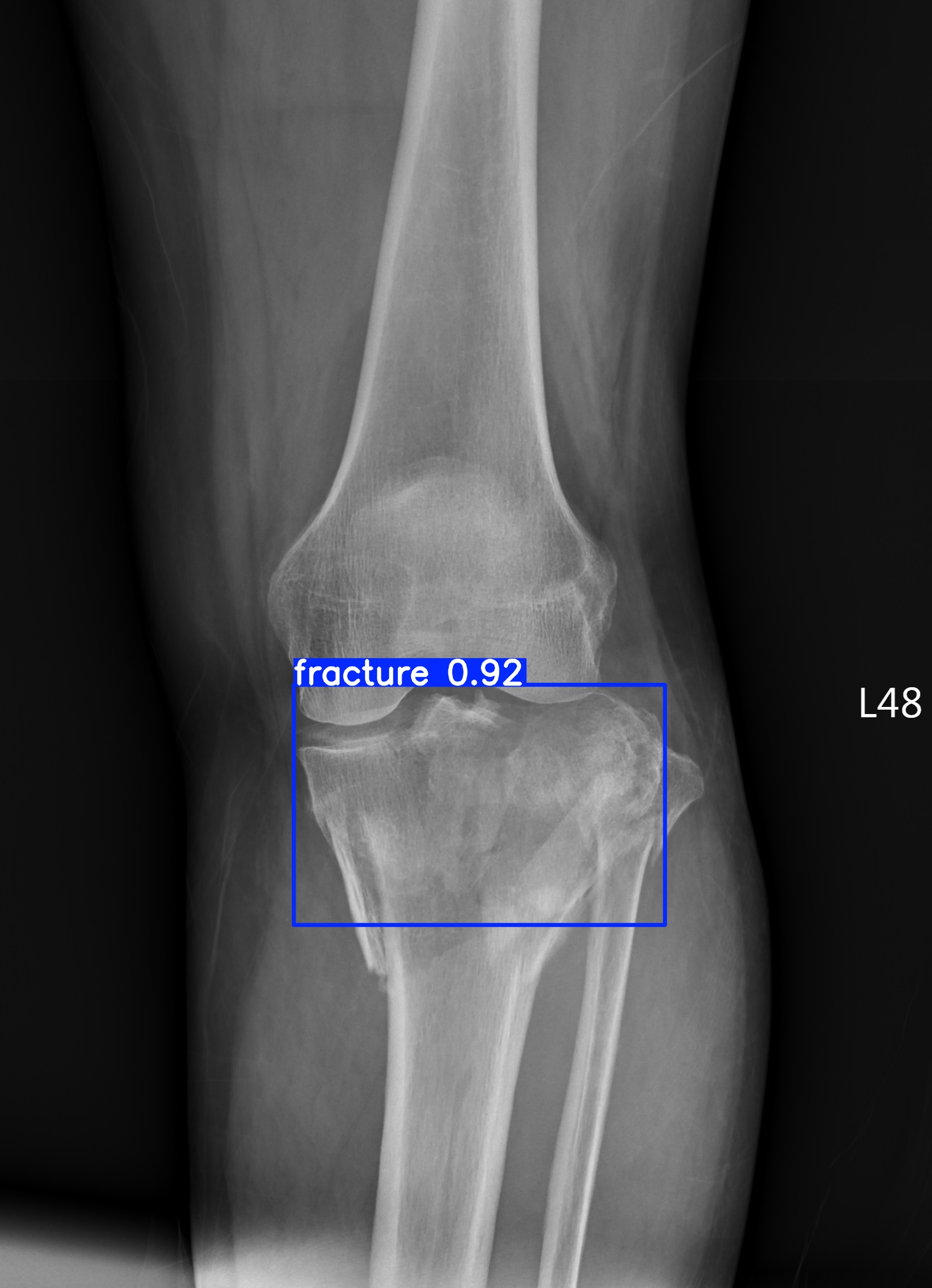 fracture_000172369J.jpg