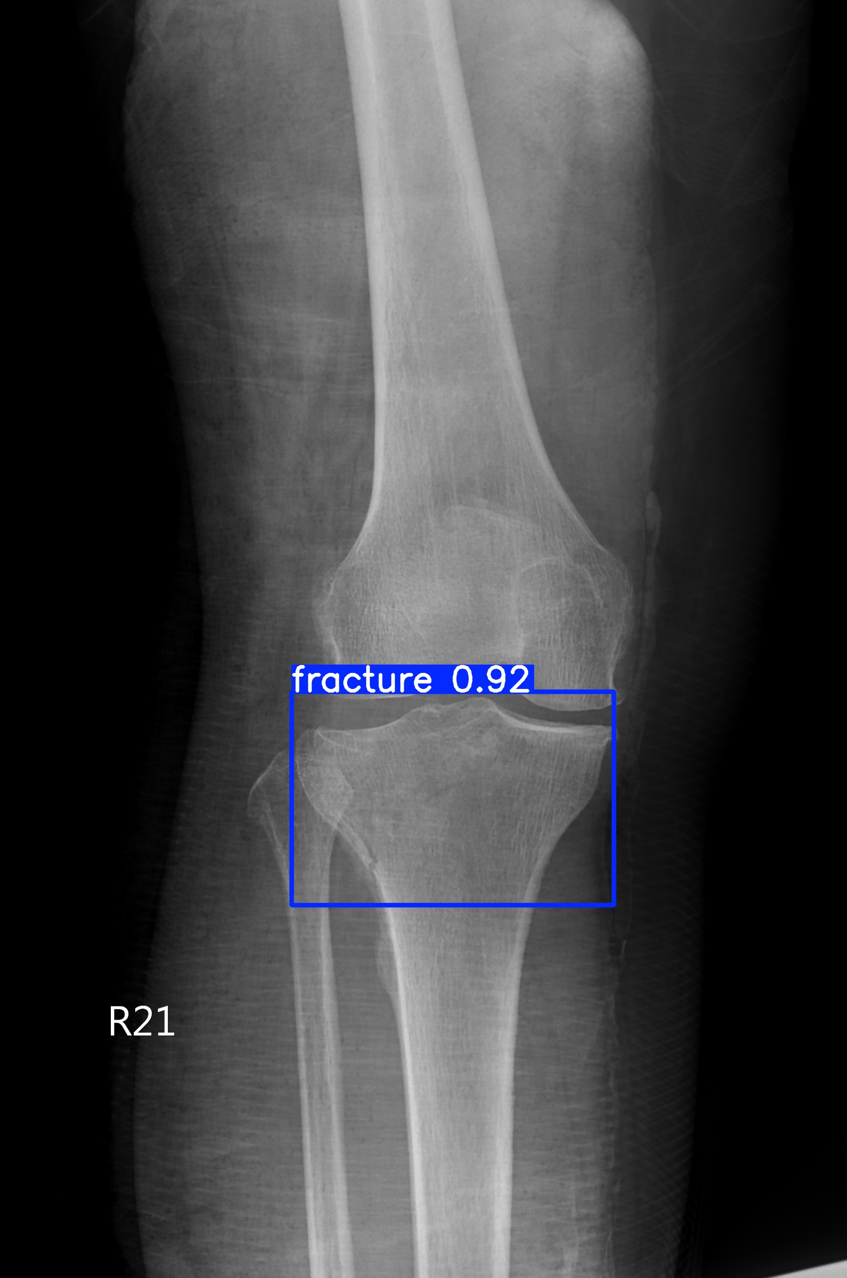 fracture_000395944C.jpg