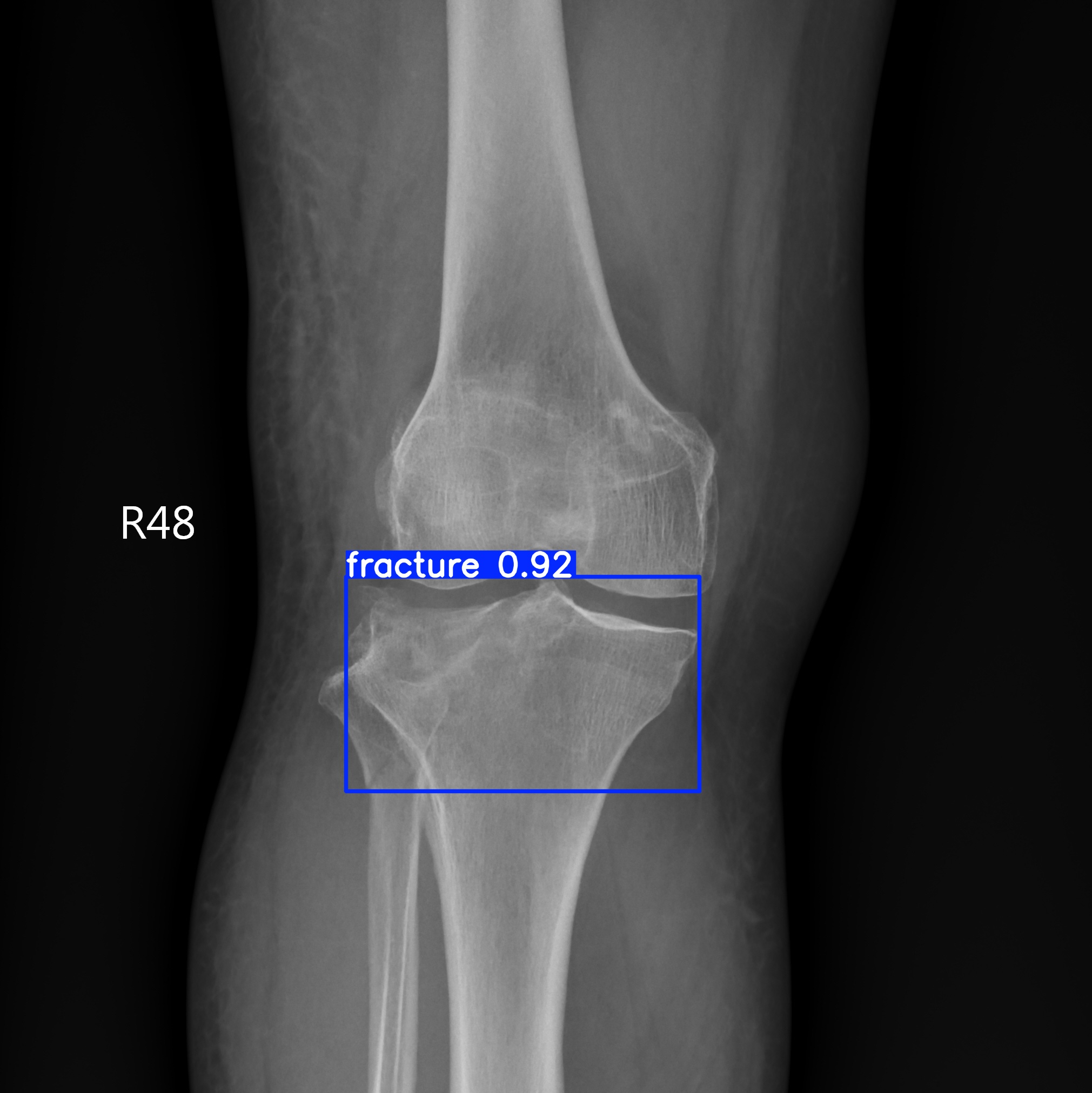 fracture_000416881E.jpg