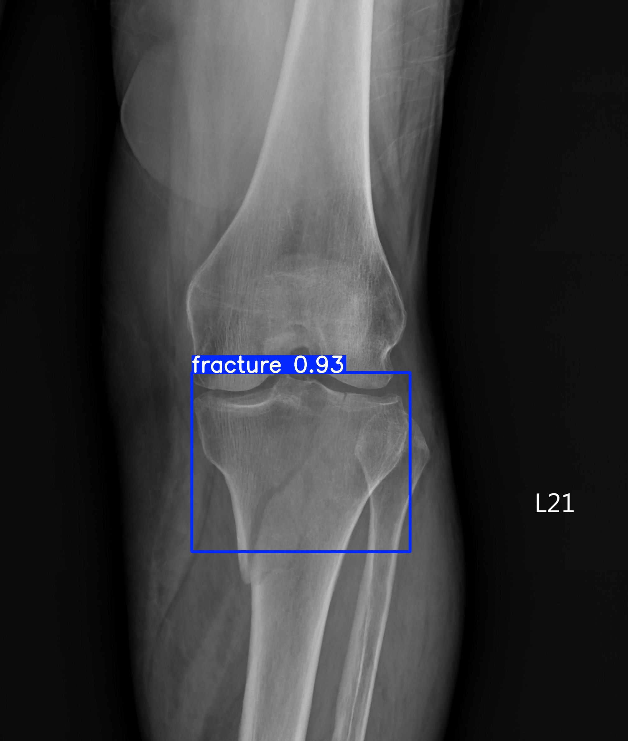 fracture_000580238A.jpg