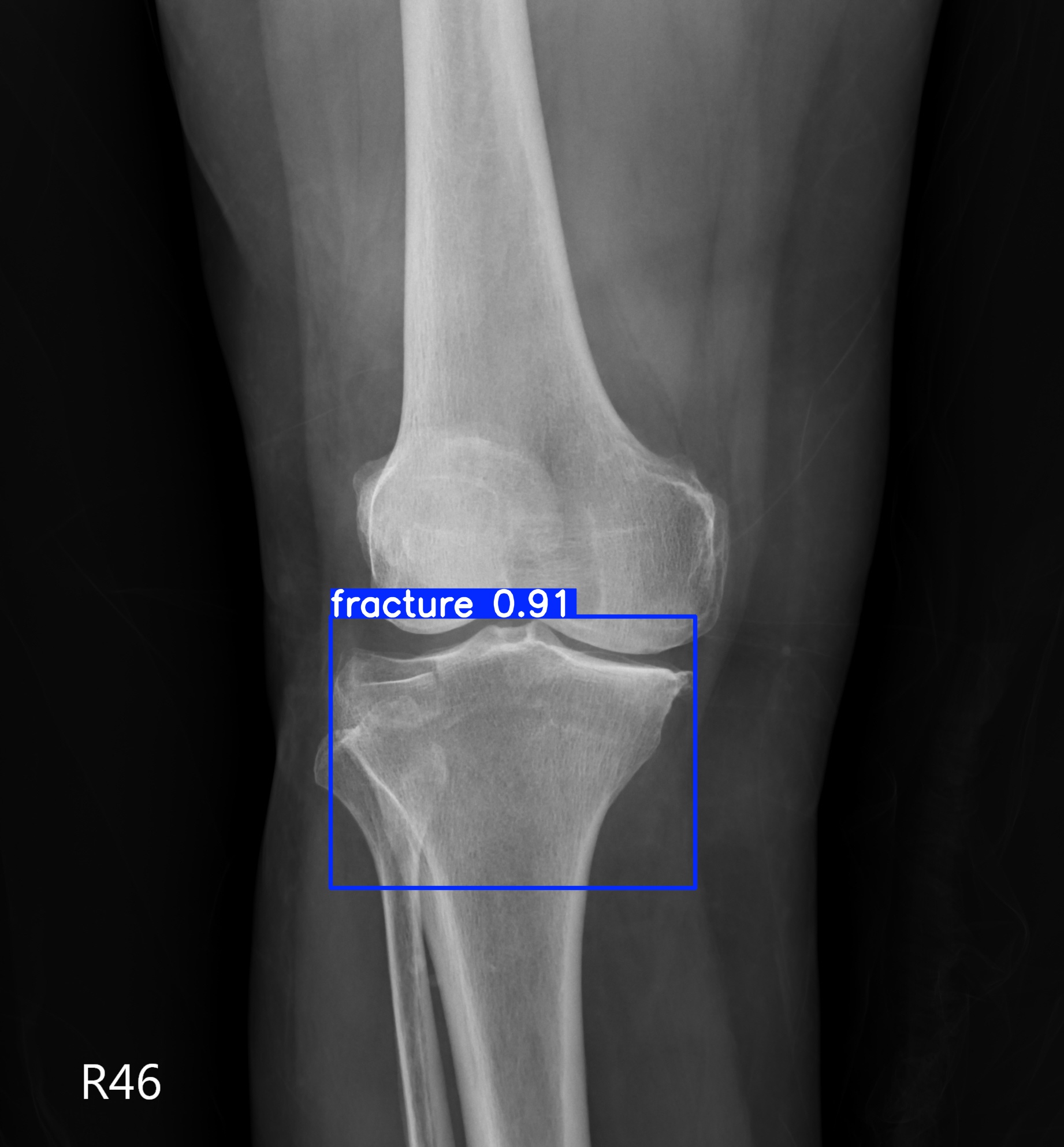 fracture_000856679I.jpg