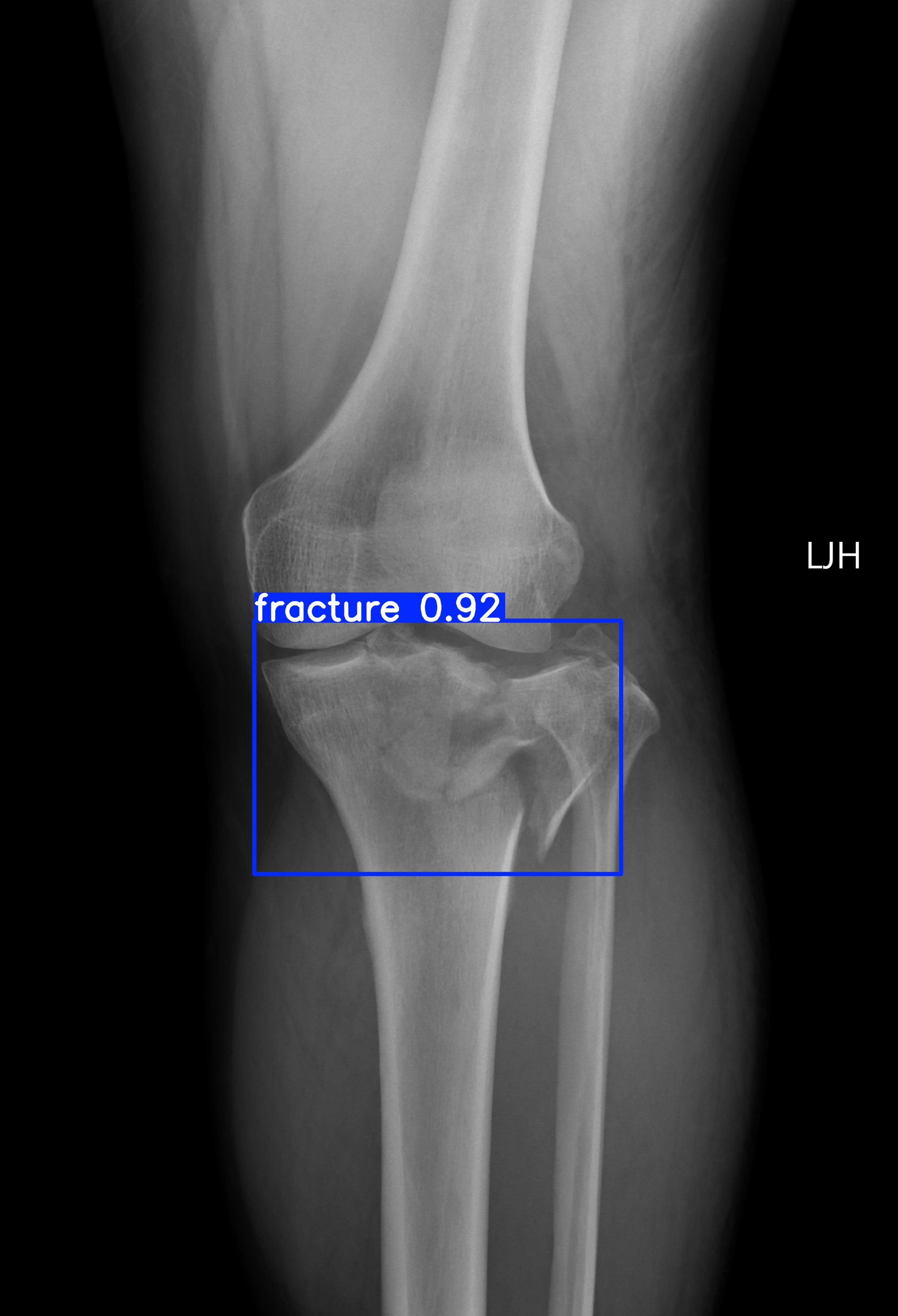 fracture_001087162C.jpg