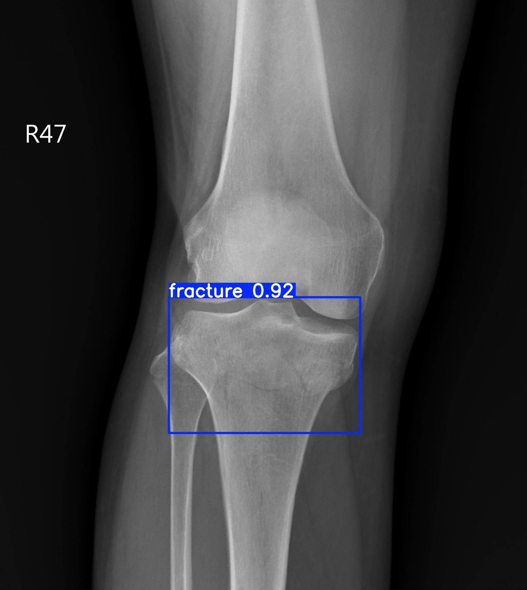 fracture_001184804H.jpg