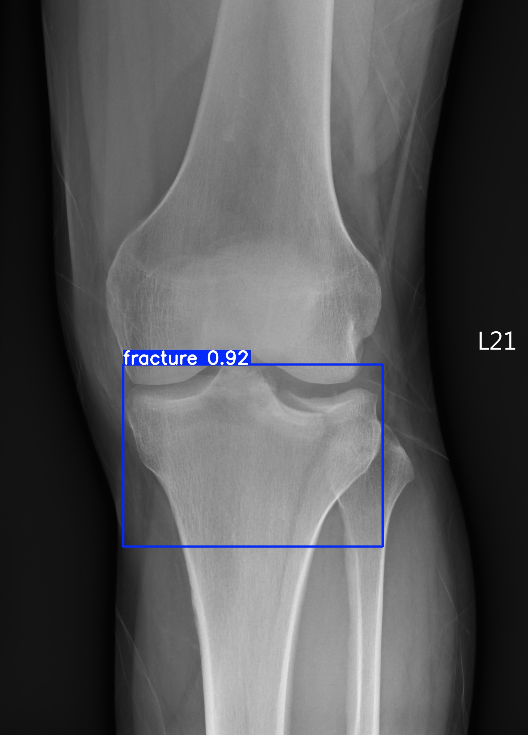 fracture_001399515I.jpg