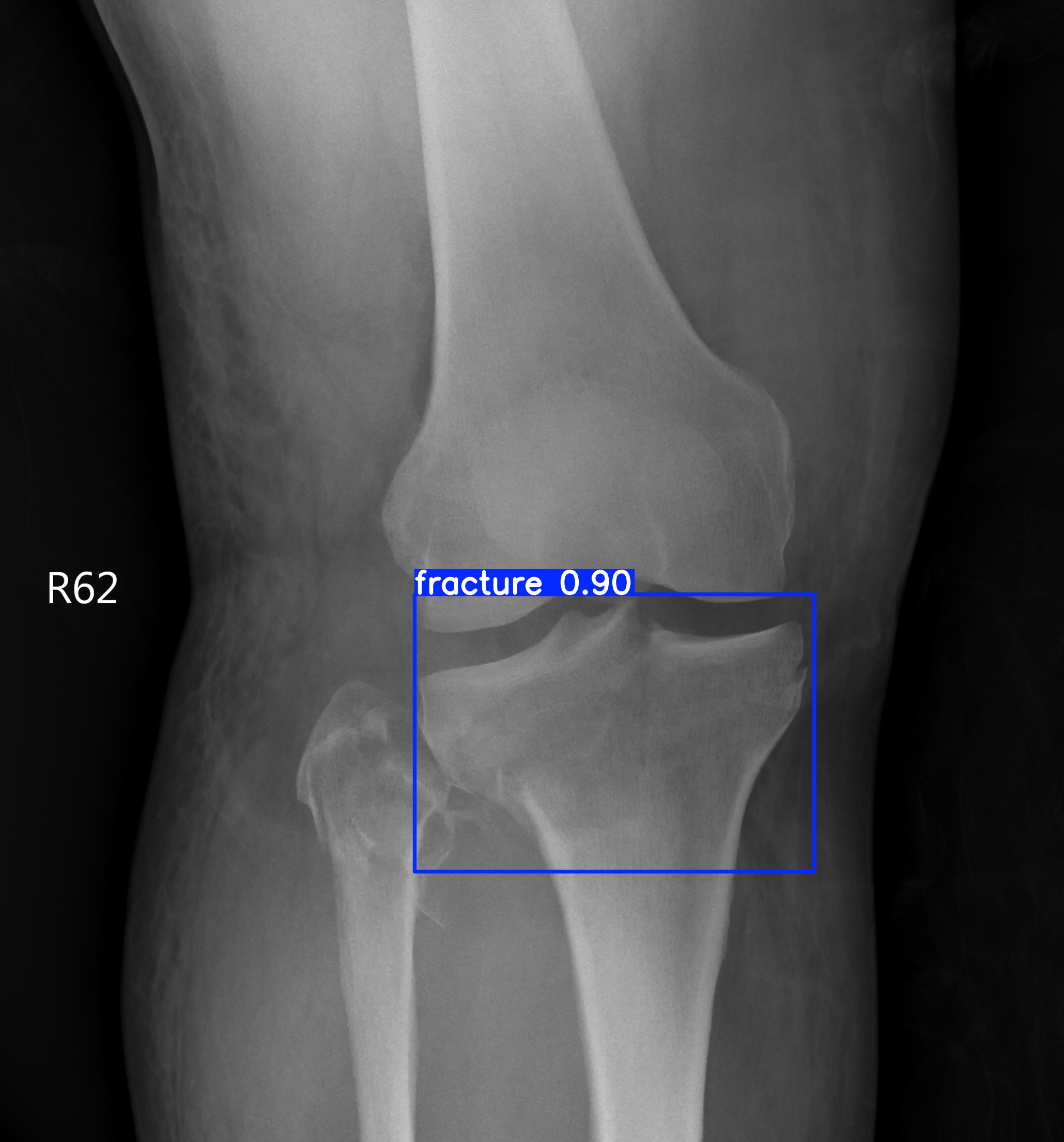 fracture_001430264I.jpg