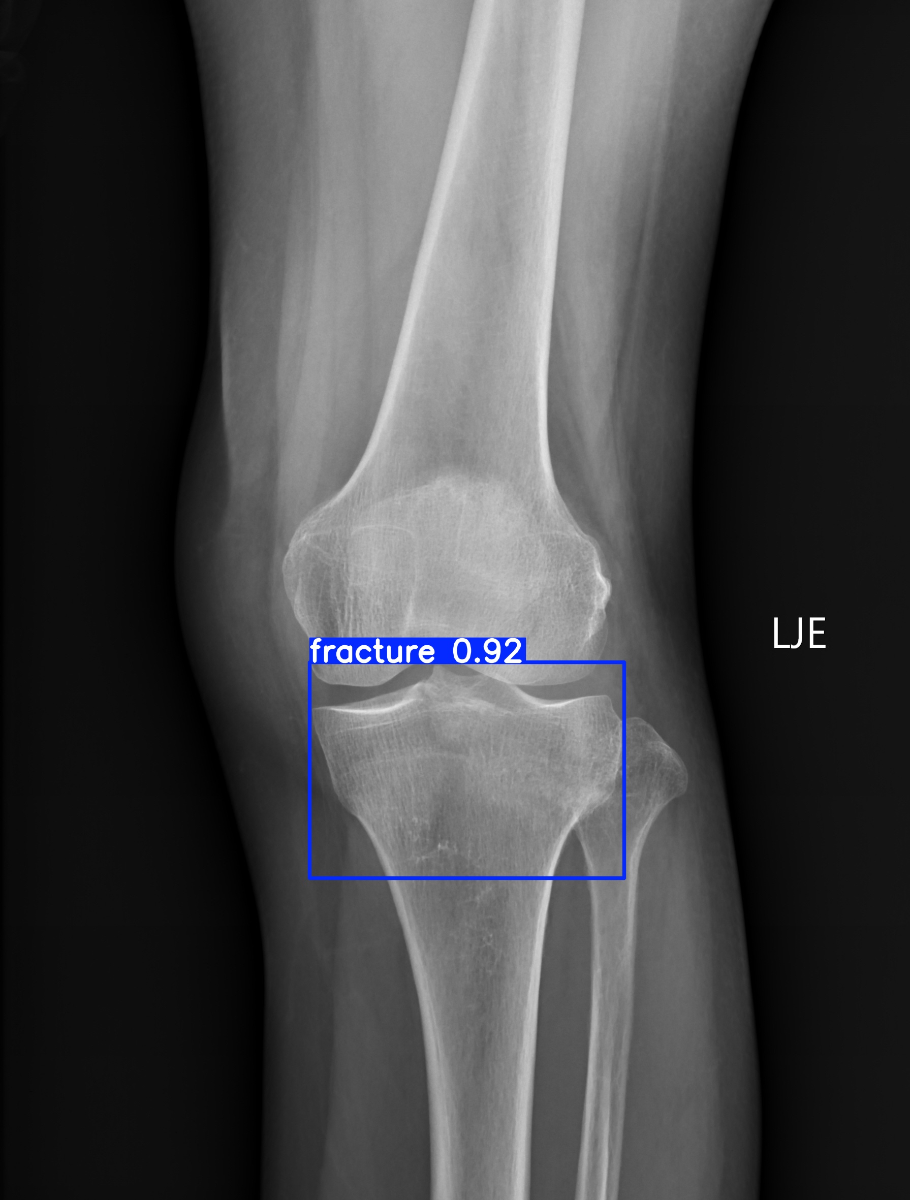 fracture_001445276H.jpg