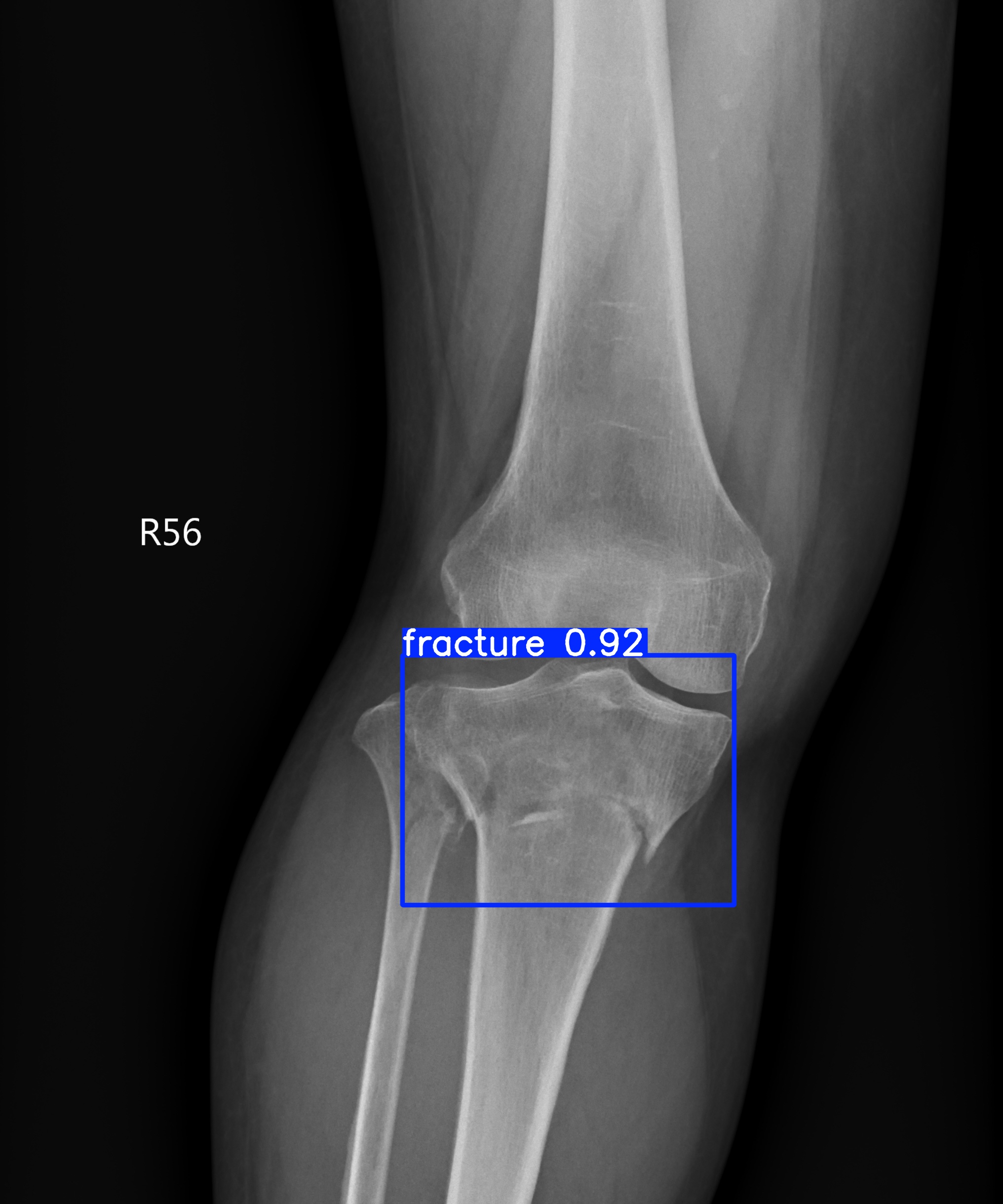 fracture_001570836I.jpg