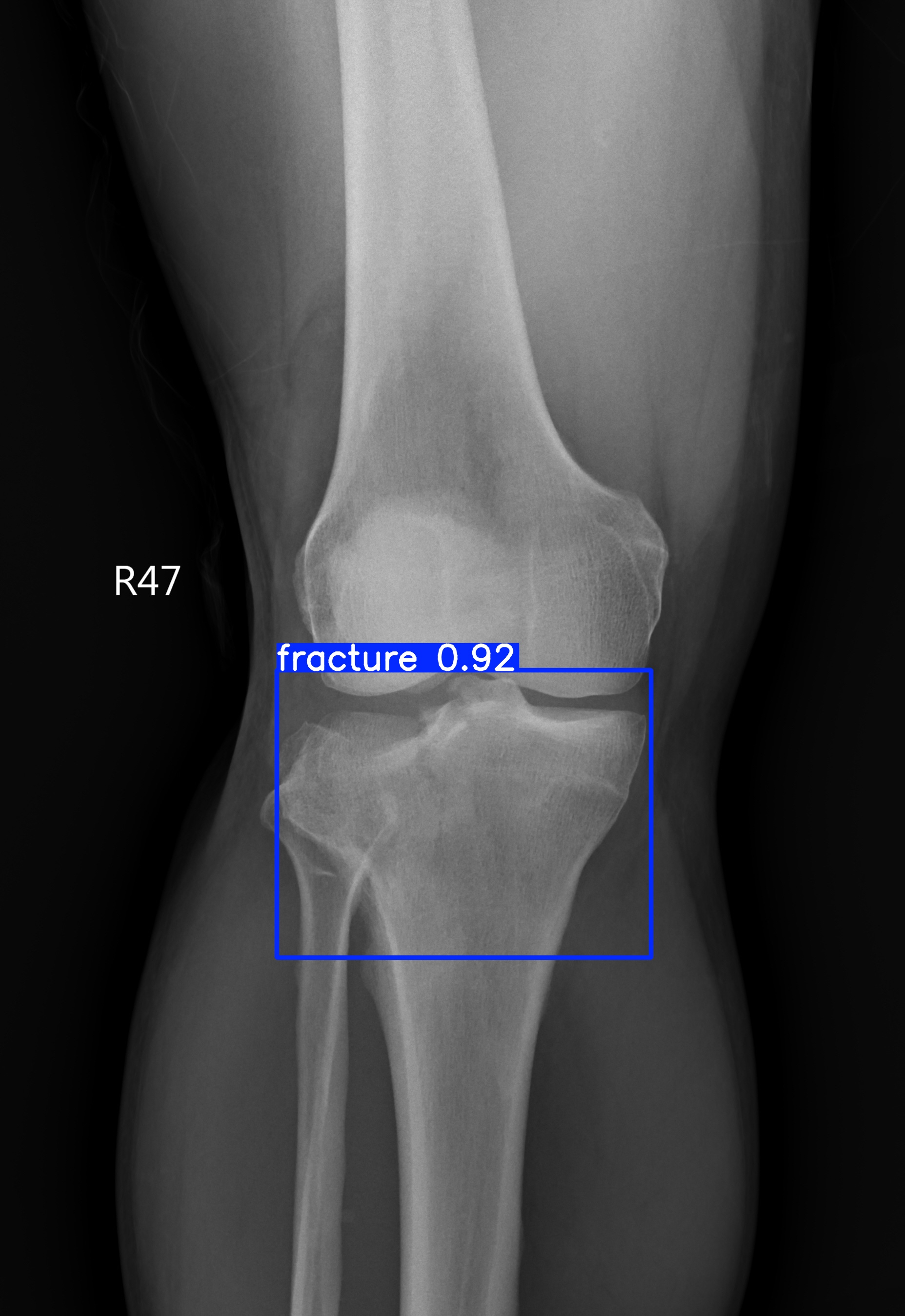 fracture_001589358A.jpg