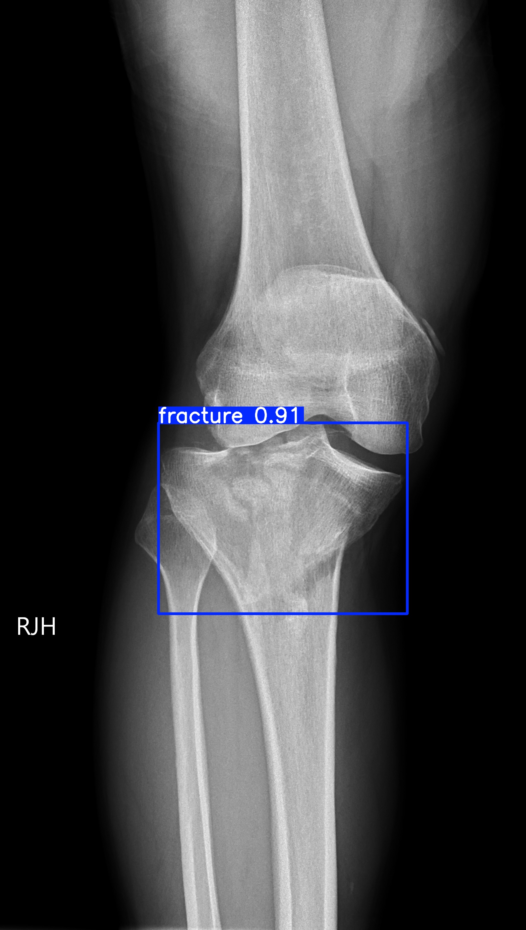 fracture_001650681D.jpg