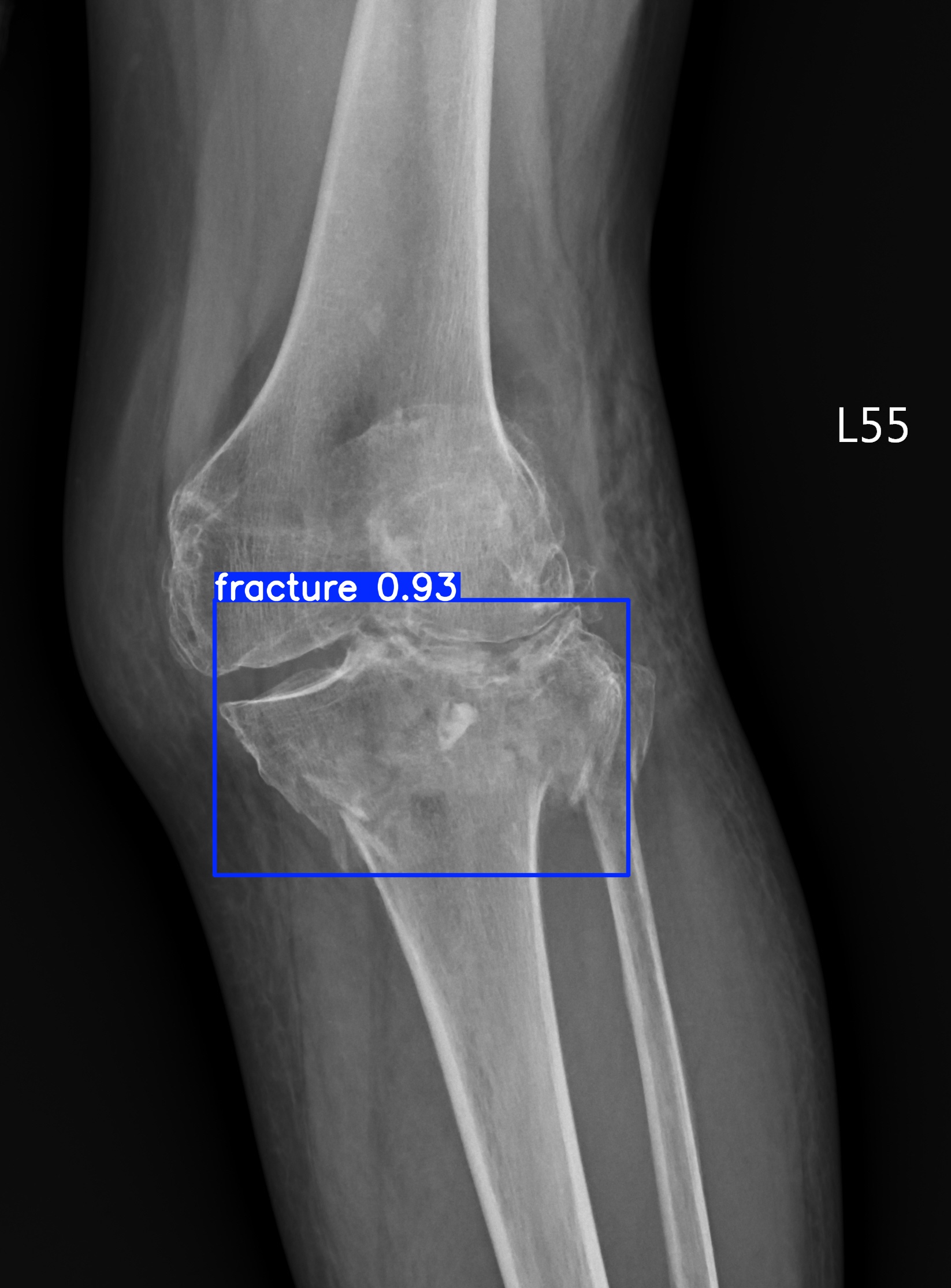 fracture_001663233A.jpg