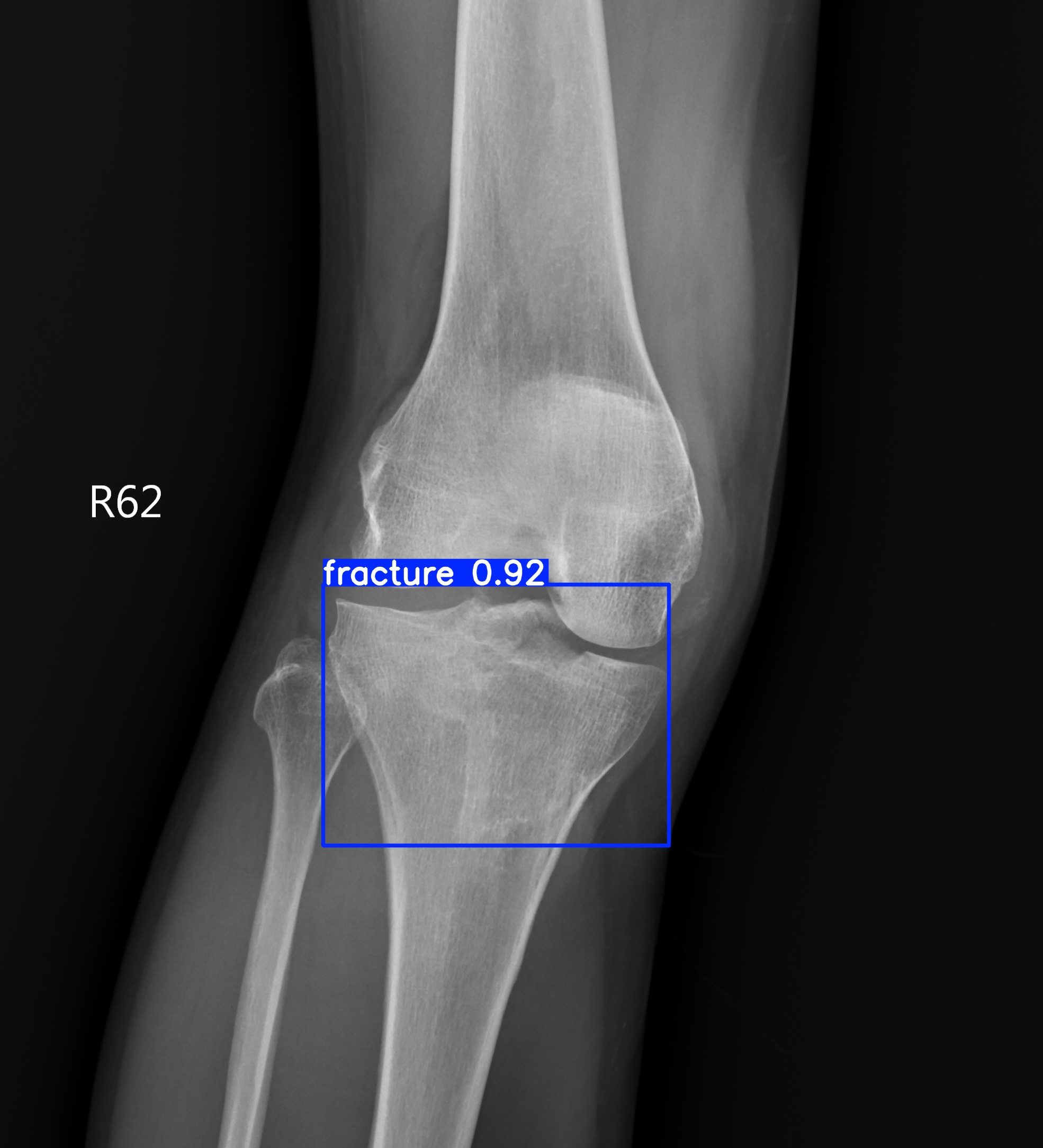 fracture_001758565I.jpg