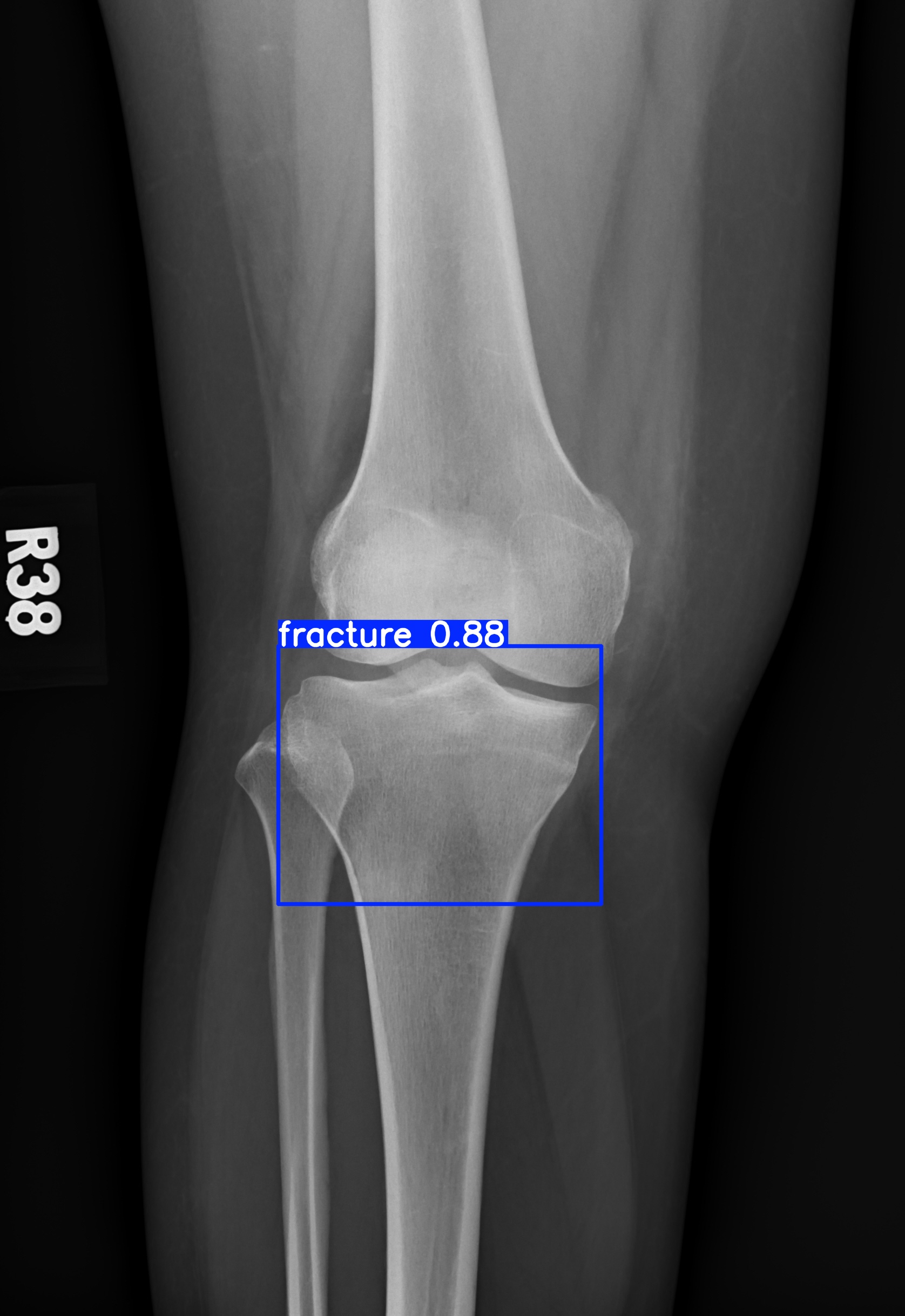 fracture_001838209H.jpg