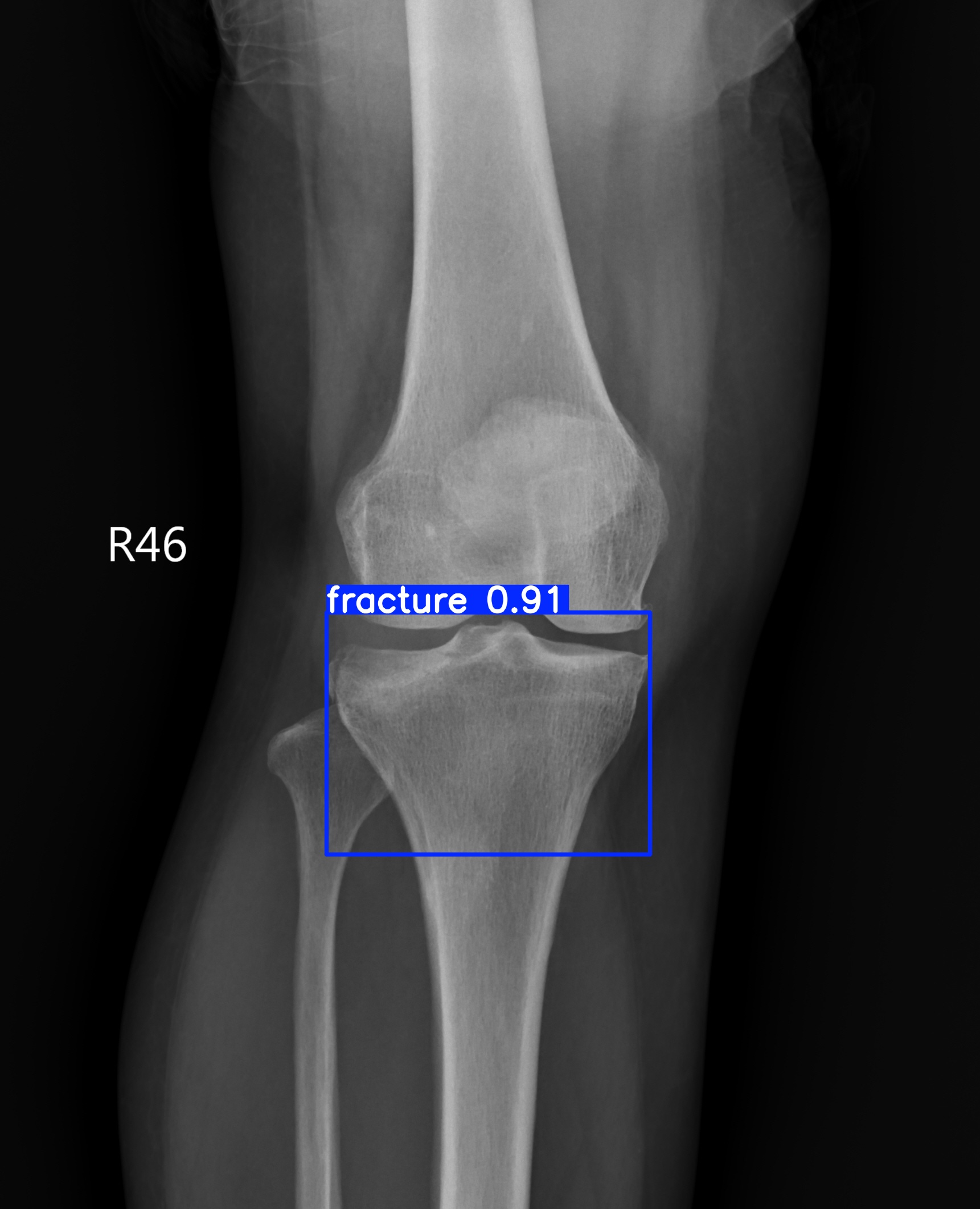fracture_001875073H.jpg