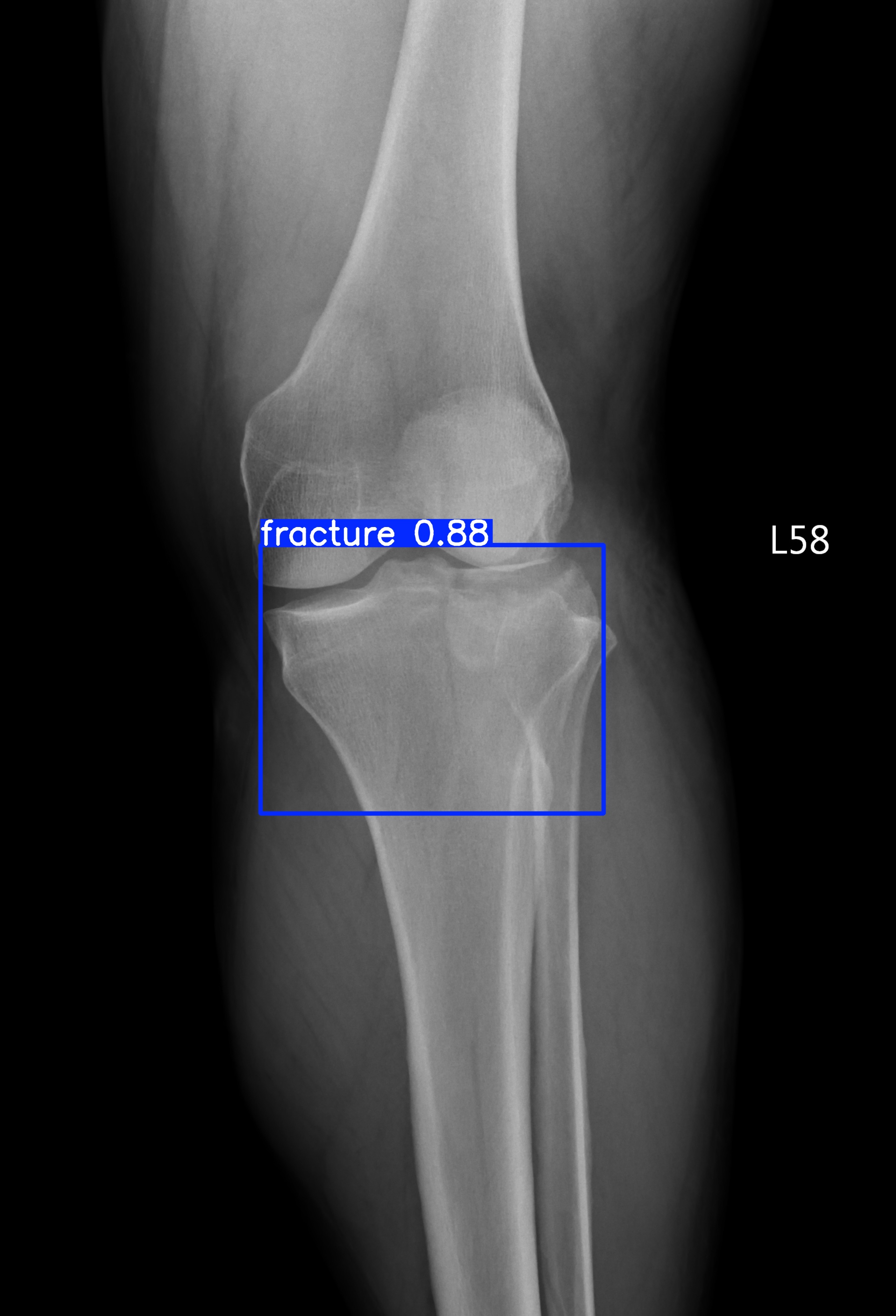 fracture_002006123I.jpg