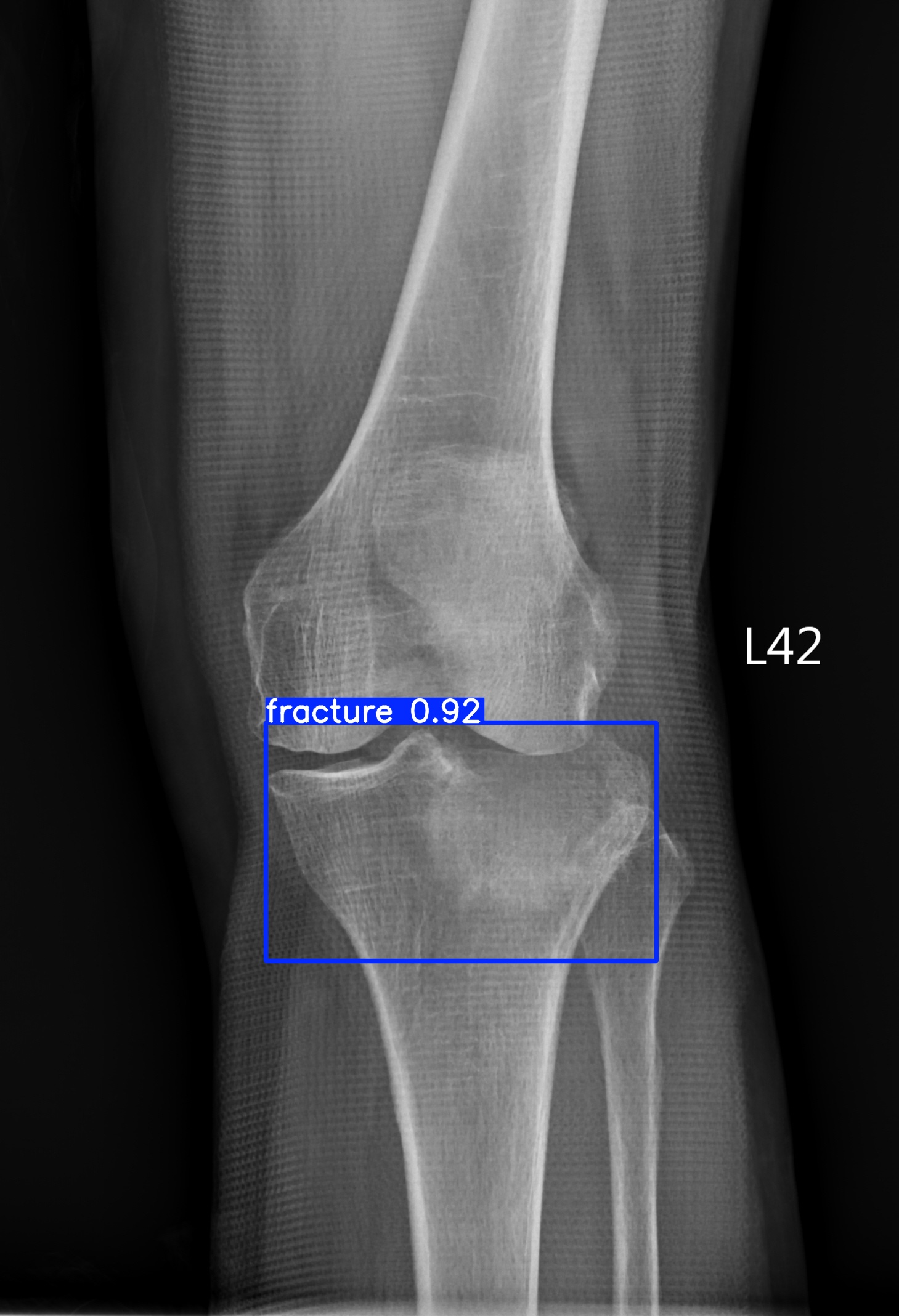 fracture_002034645G.jpg