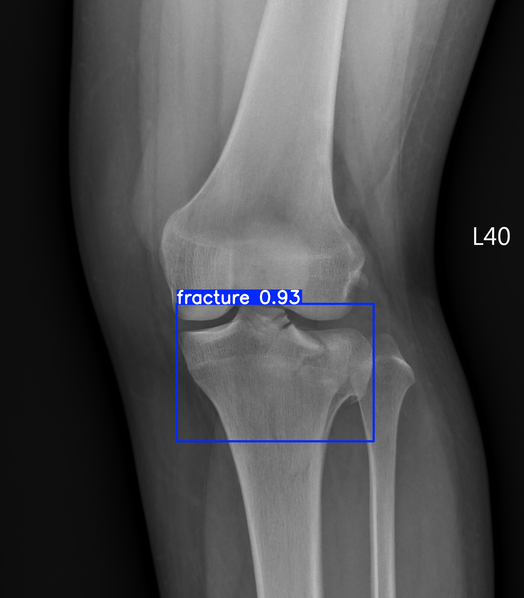 fracture_002124542B.jpg