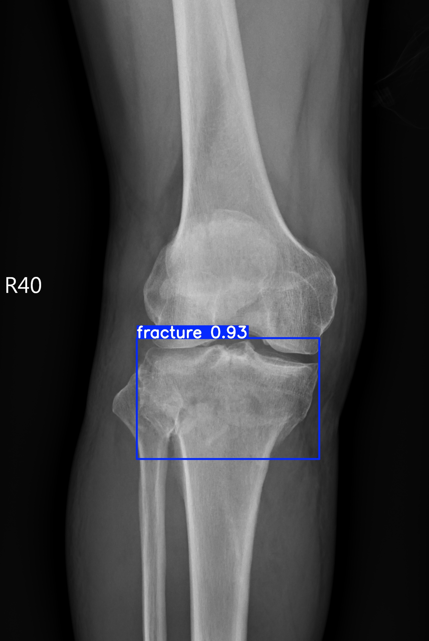 fracture_002579226B.jpg