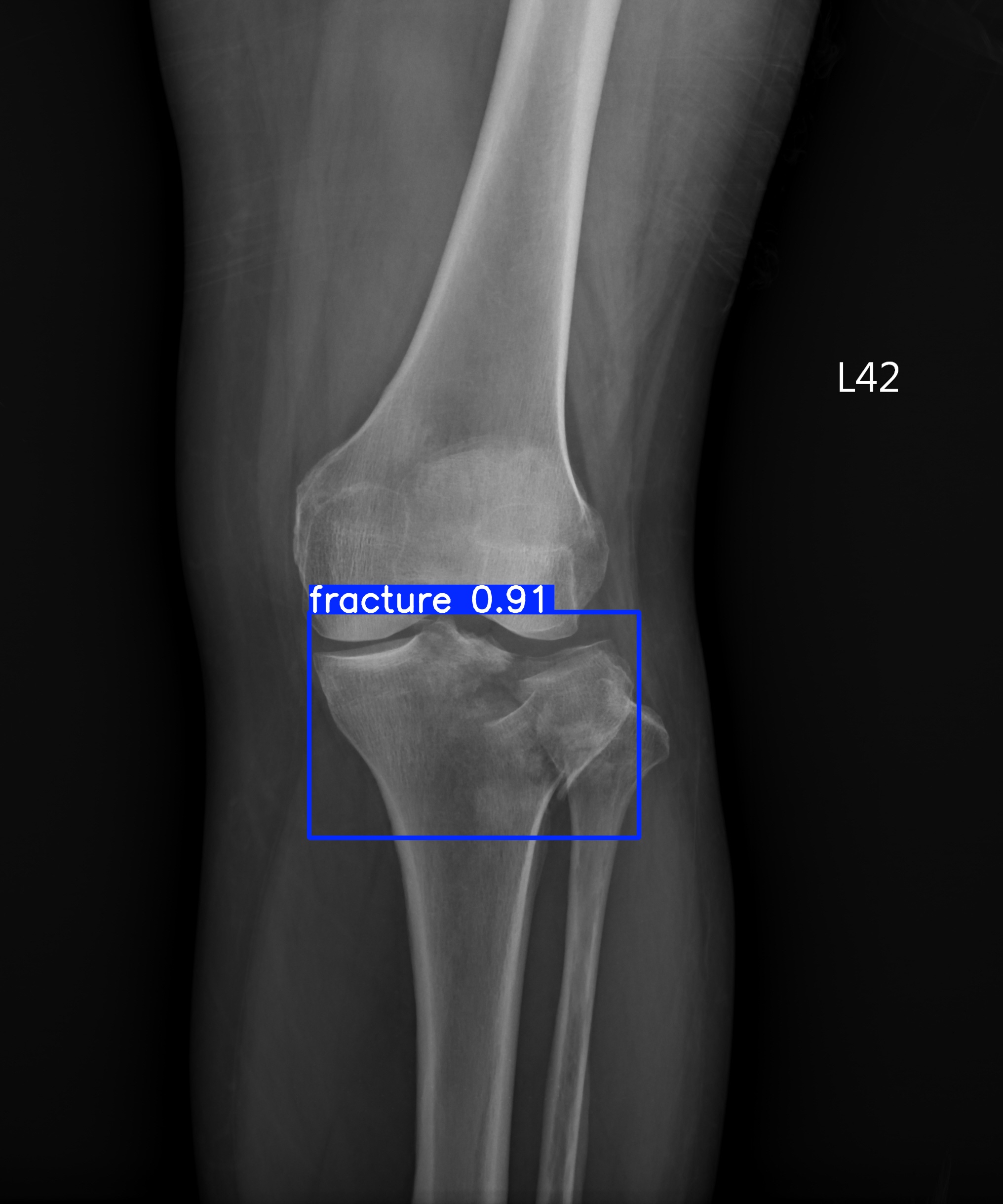 fracture_002607554H.jpg