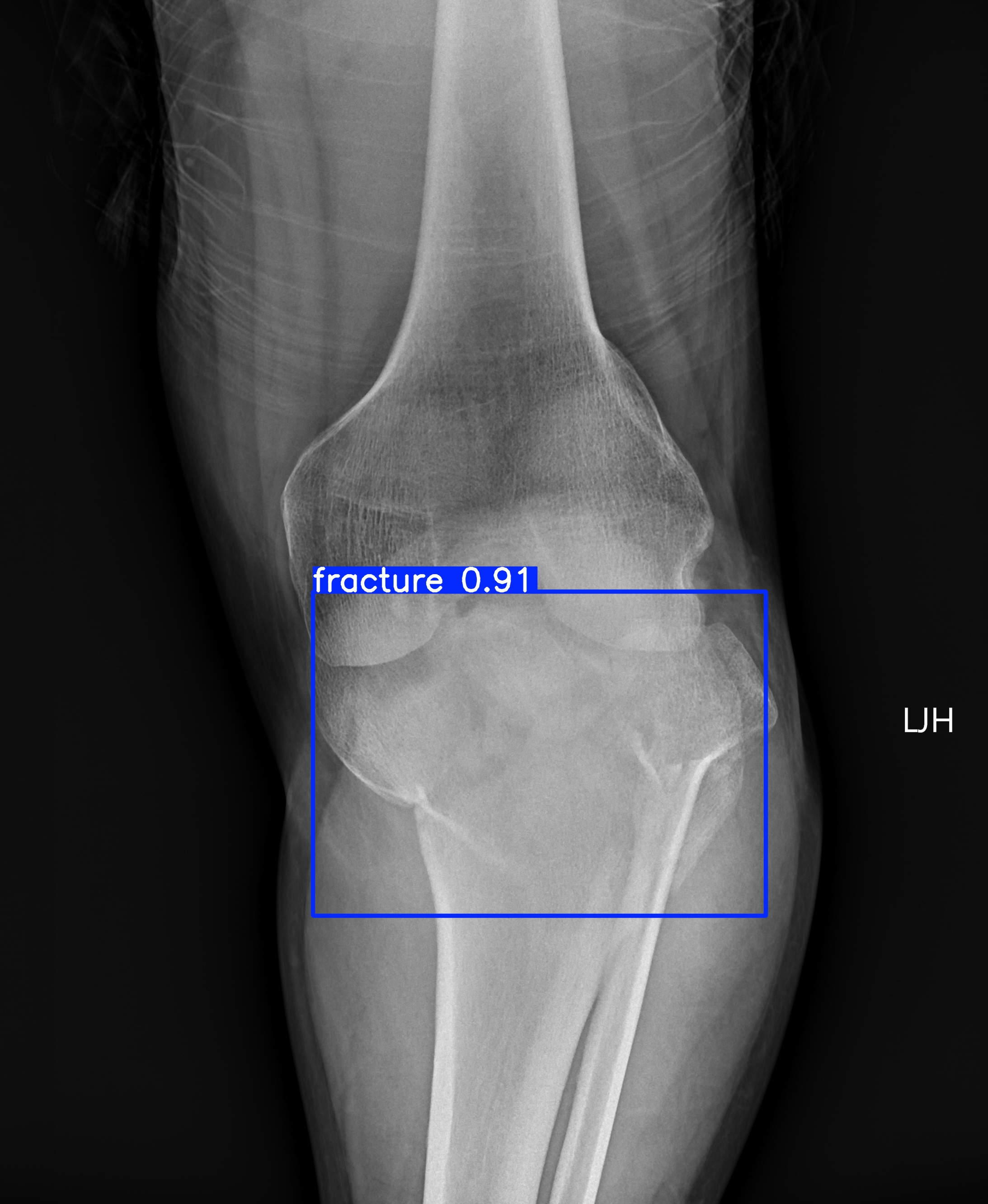 fracture_002778420J.jpg