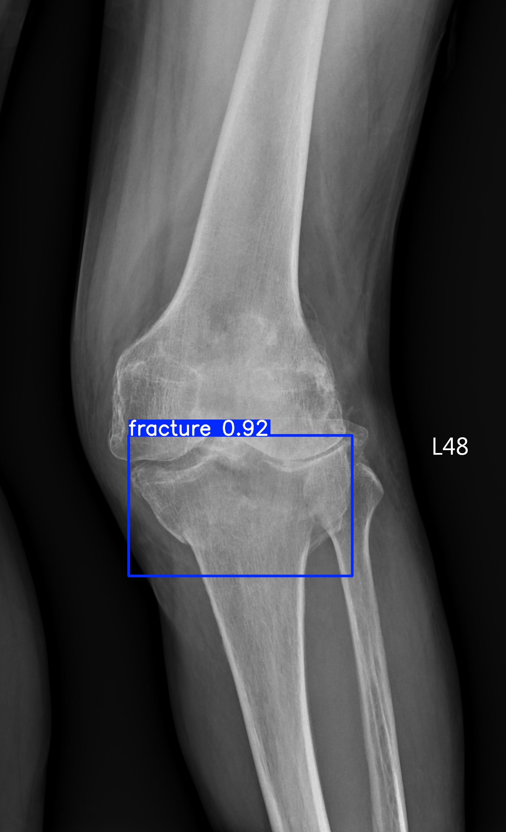 fracture_002821149G.jpg