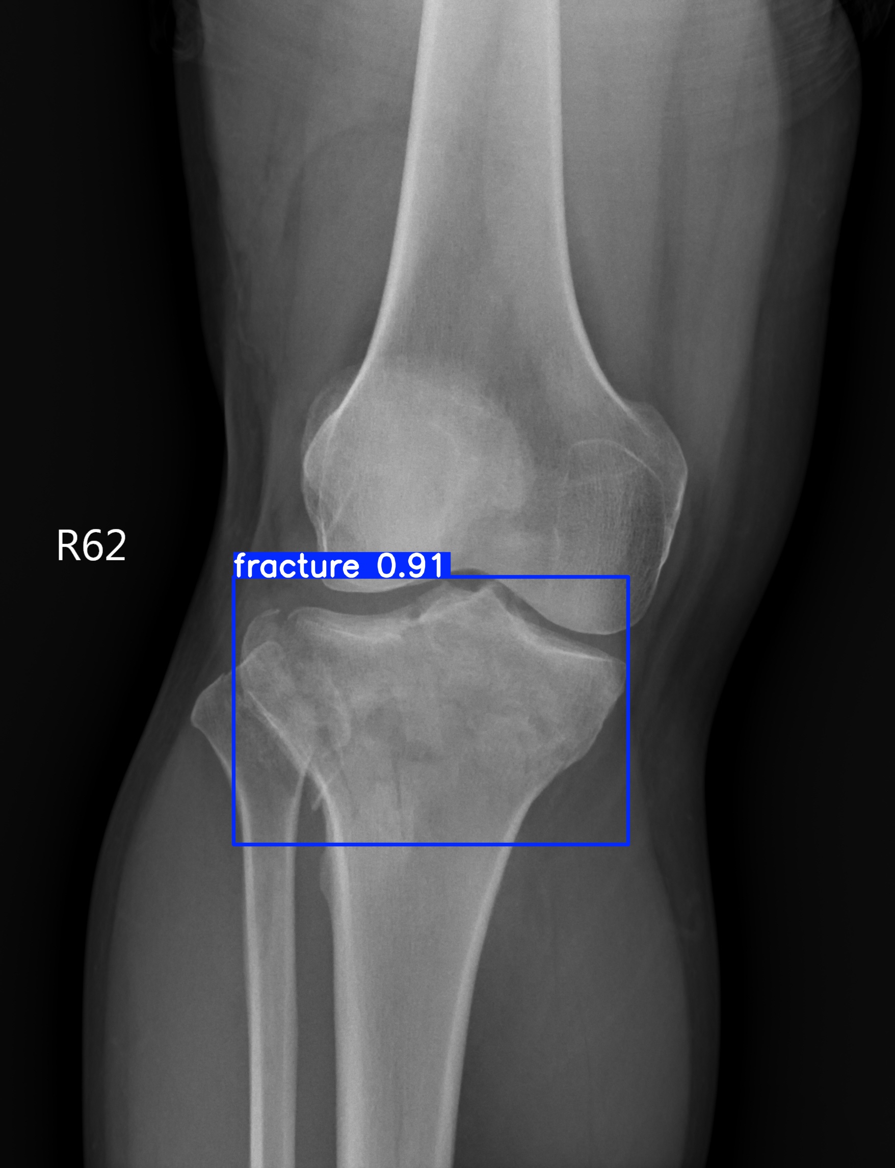 fracture_002835058F.jpg