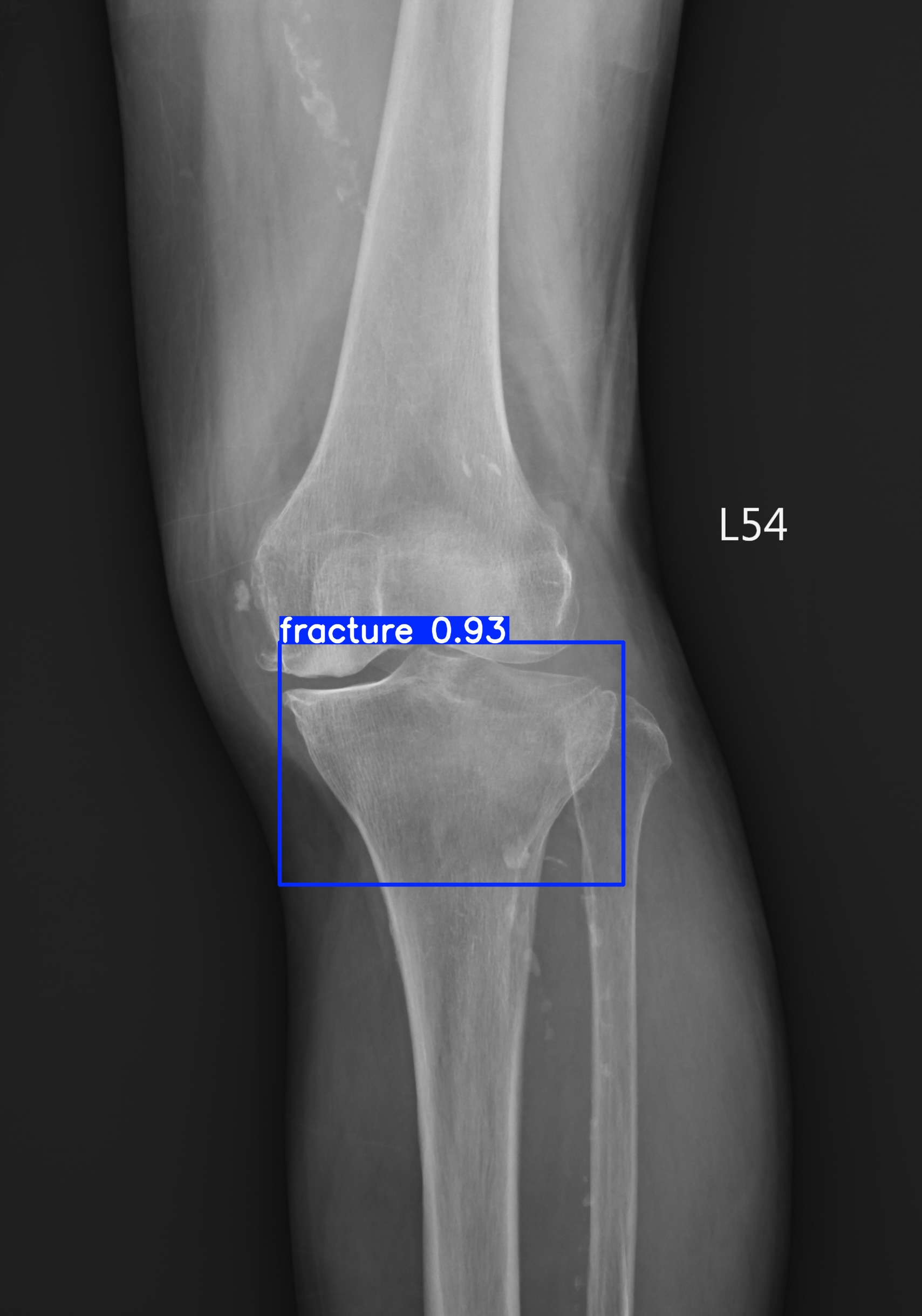 fracture_003133500J.jpg