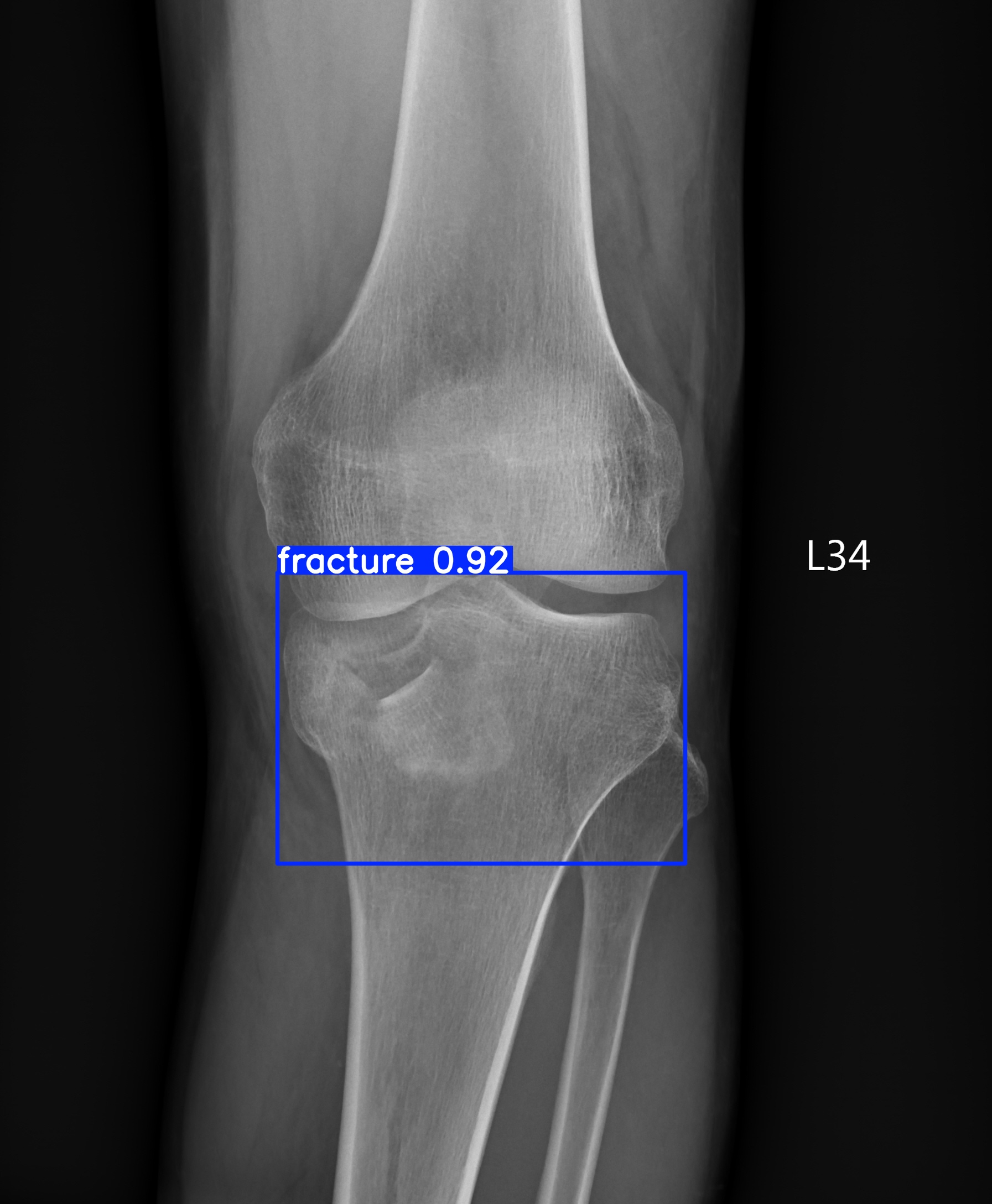 fracture_003172925G.jpg