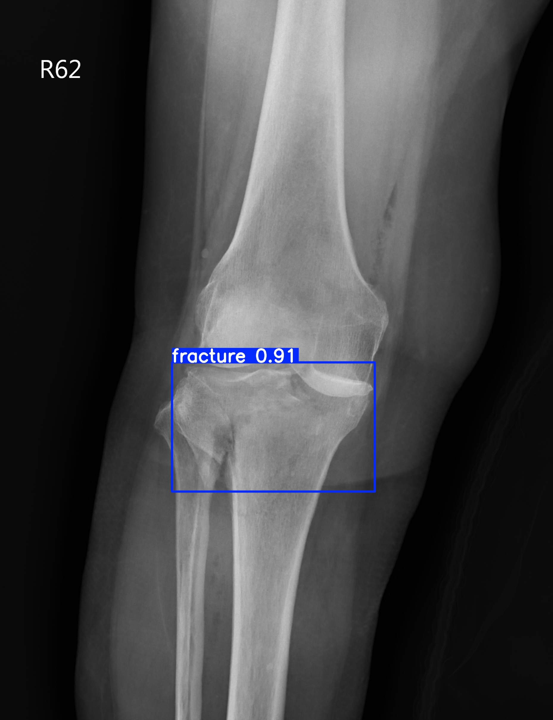fracture_003186252J.jpg