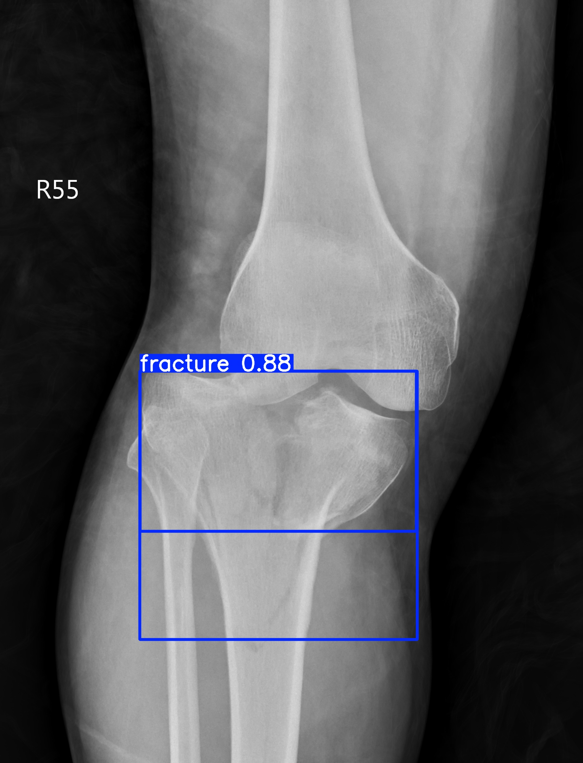 fracture_003190269J.jpg