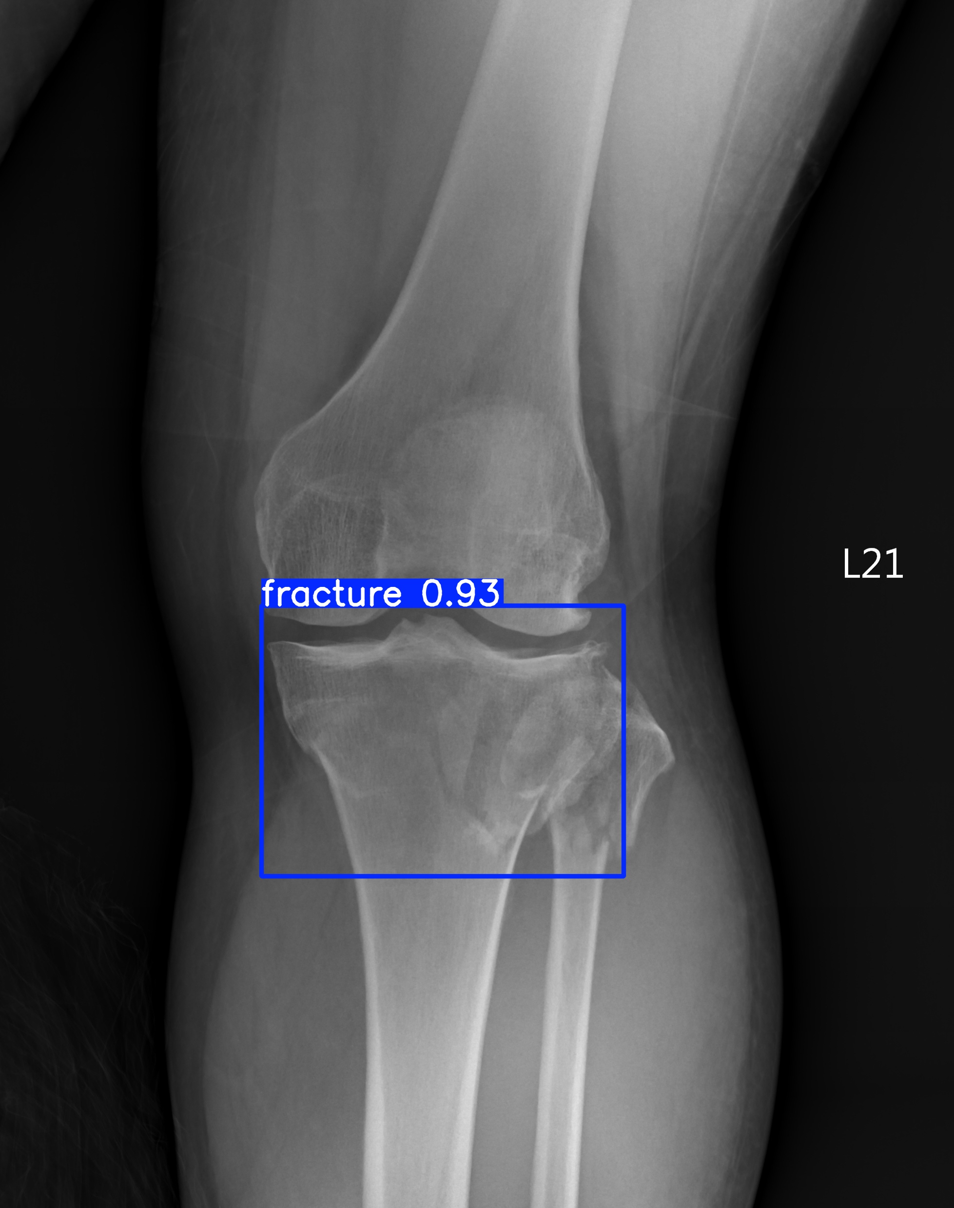 fracture_003192429F.jpg