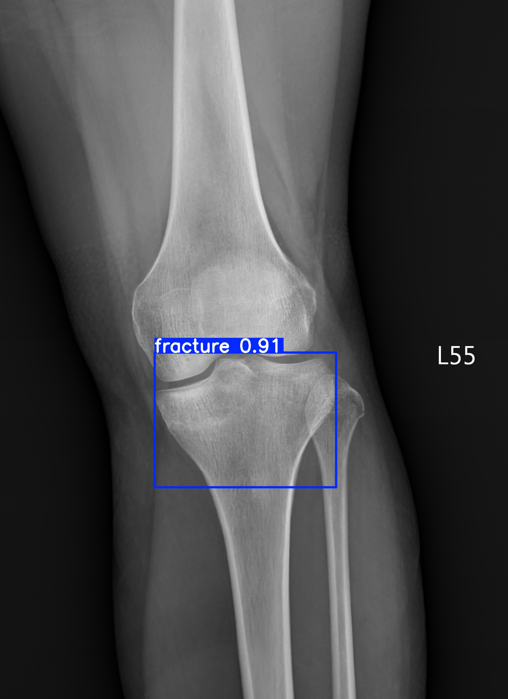 fracture_003196300F.jpg