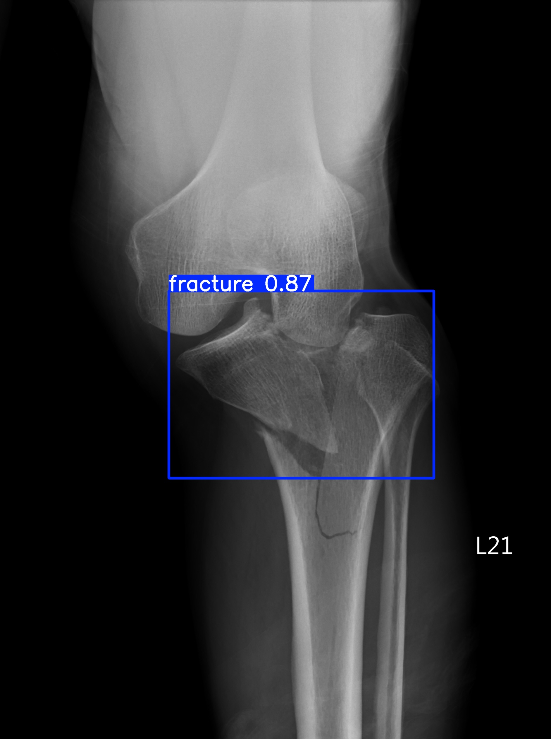 fracture_003196577C.jpg