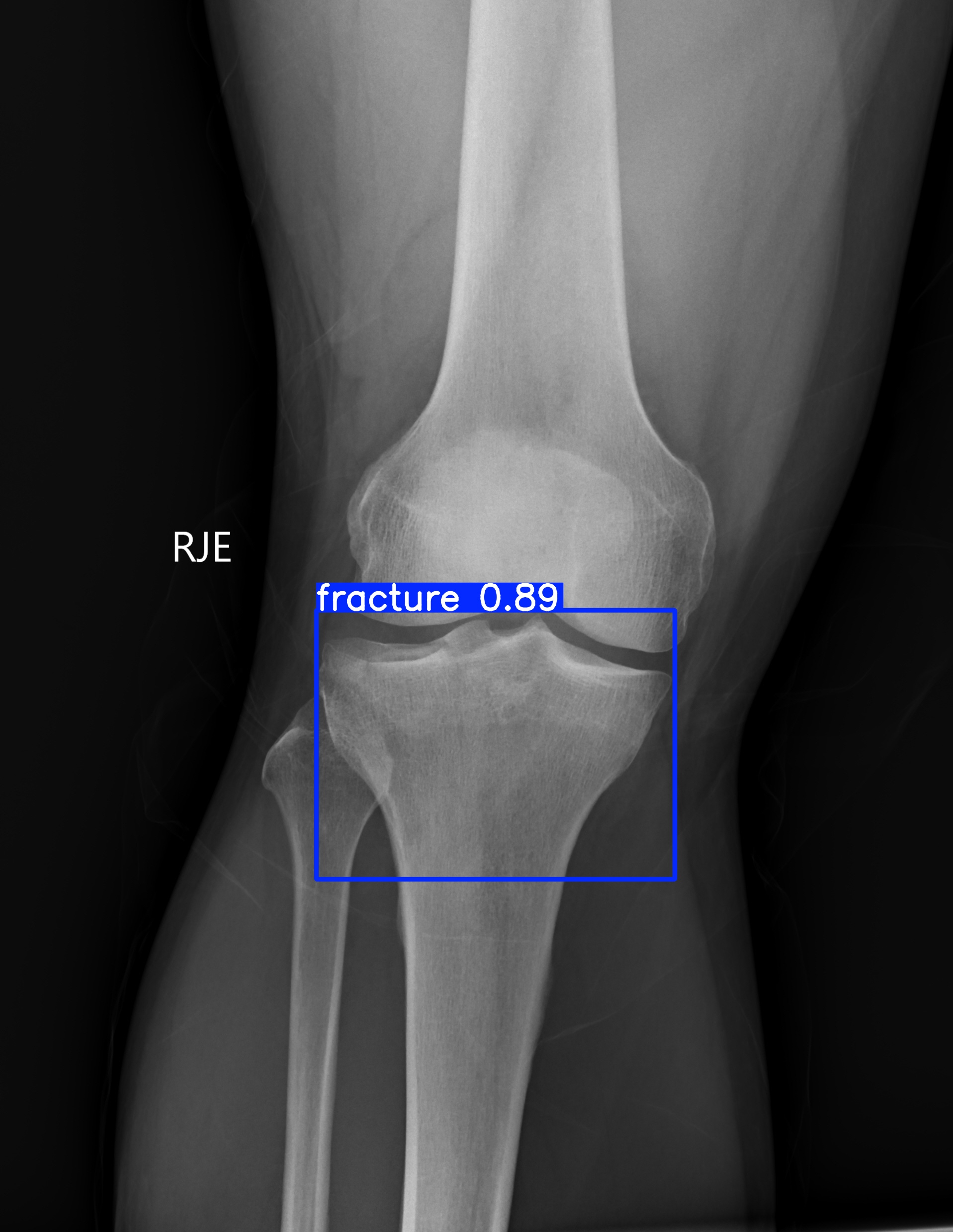 fracture_003210930B.jpg