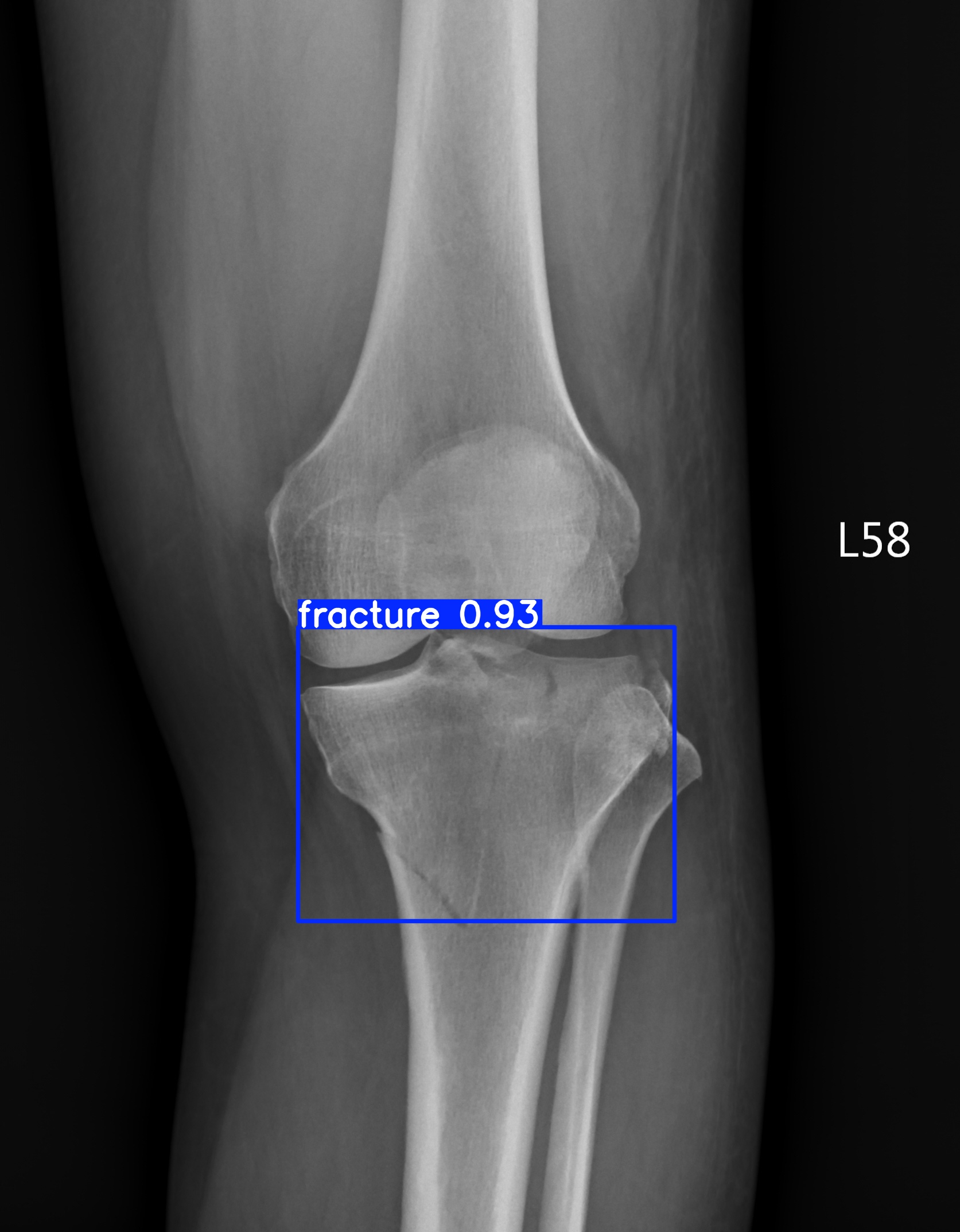 fracture_003213820I.jpg