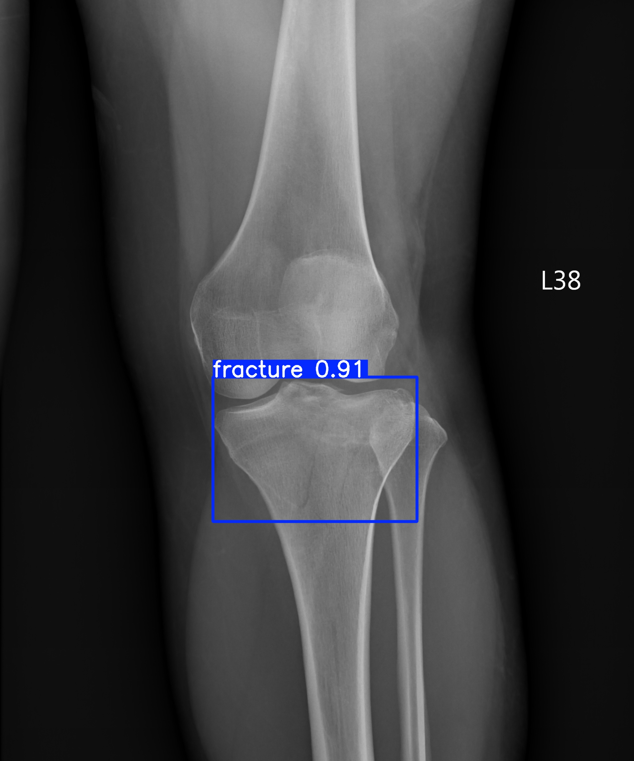 fracture_003217380B.jpg