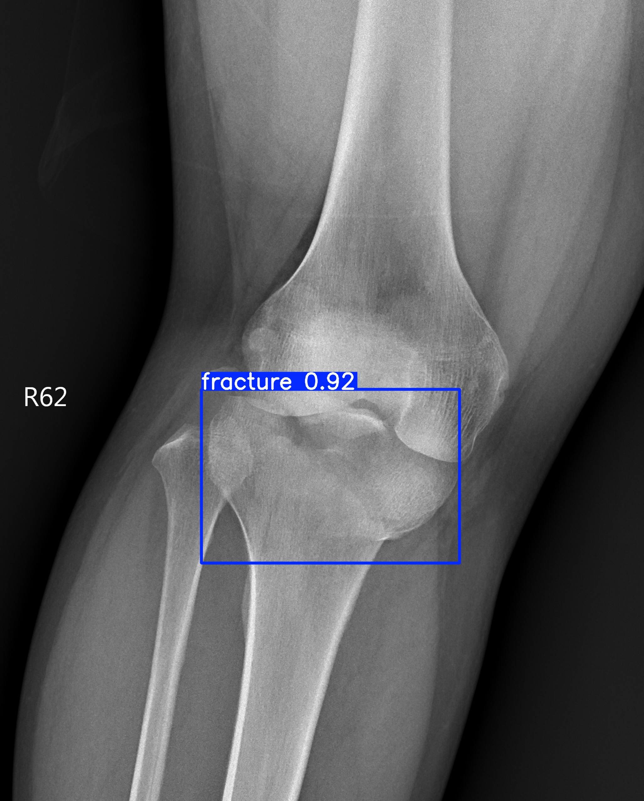fracture_003259760H.jpg
