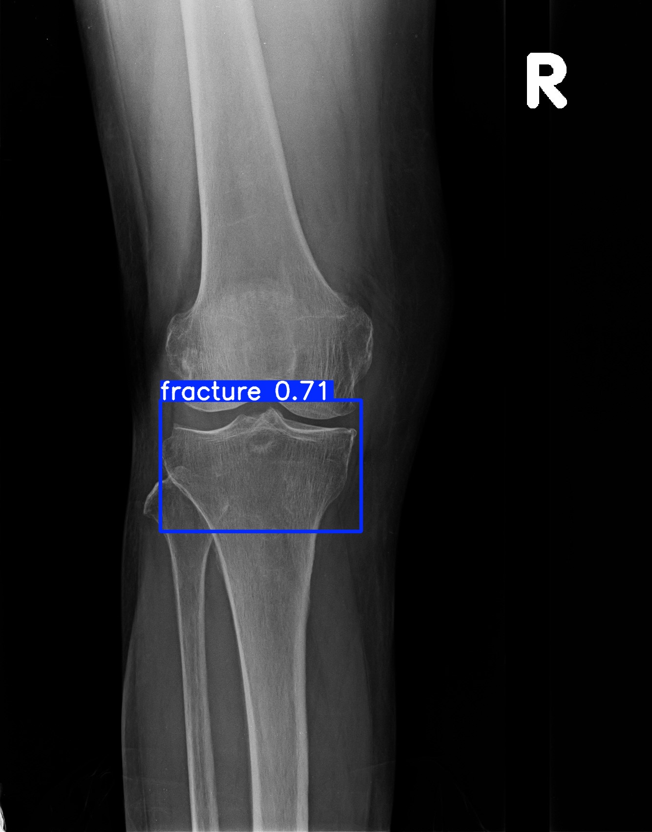 fracture_1 (14).jpg