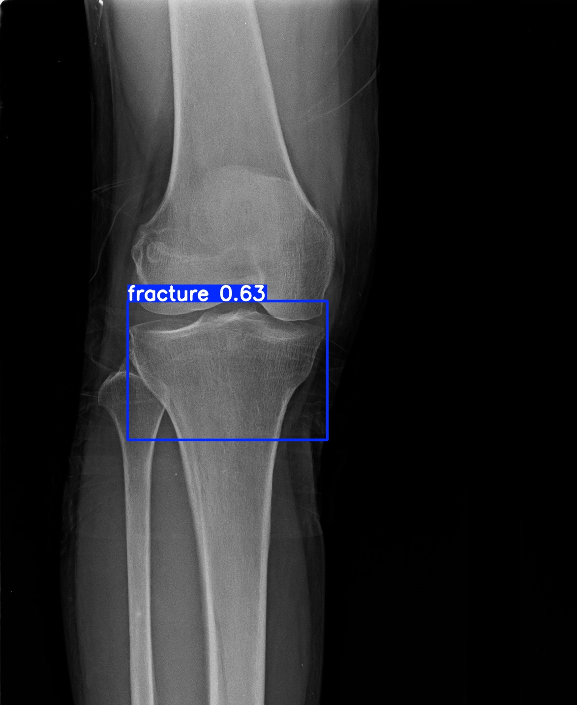 fracture_1 (6).jpg