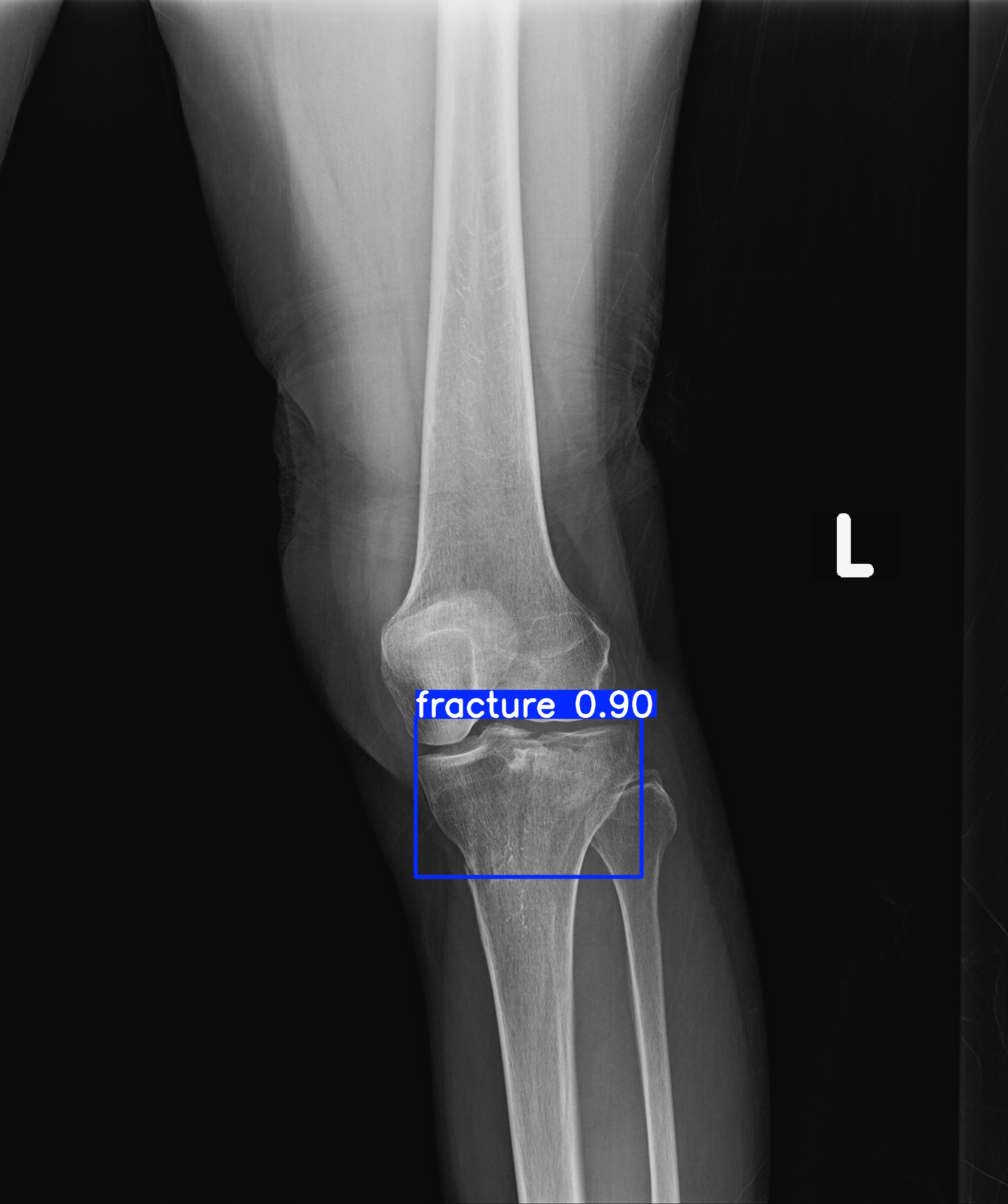 fracture_1-1.jpg