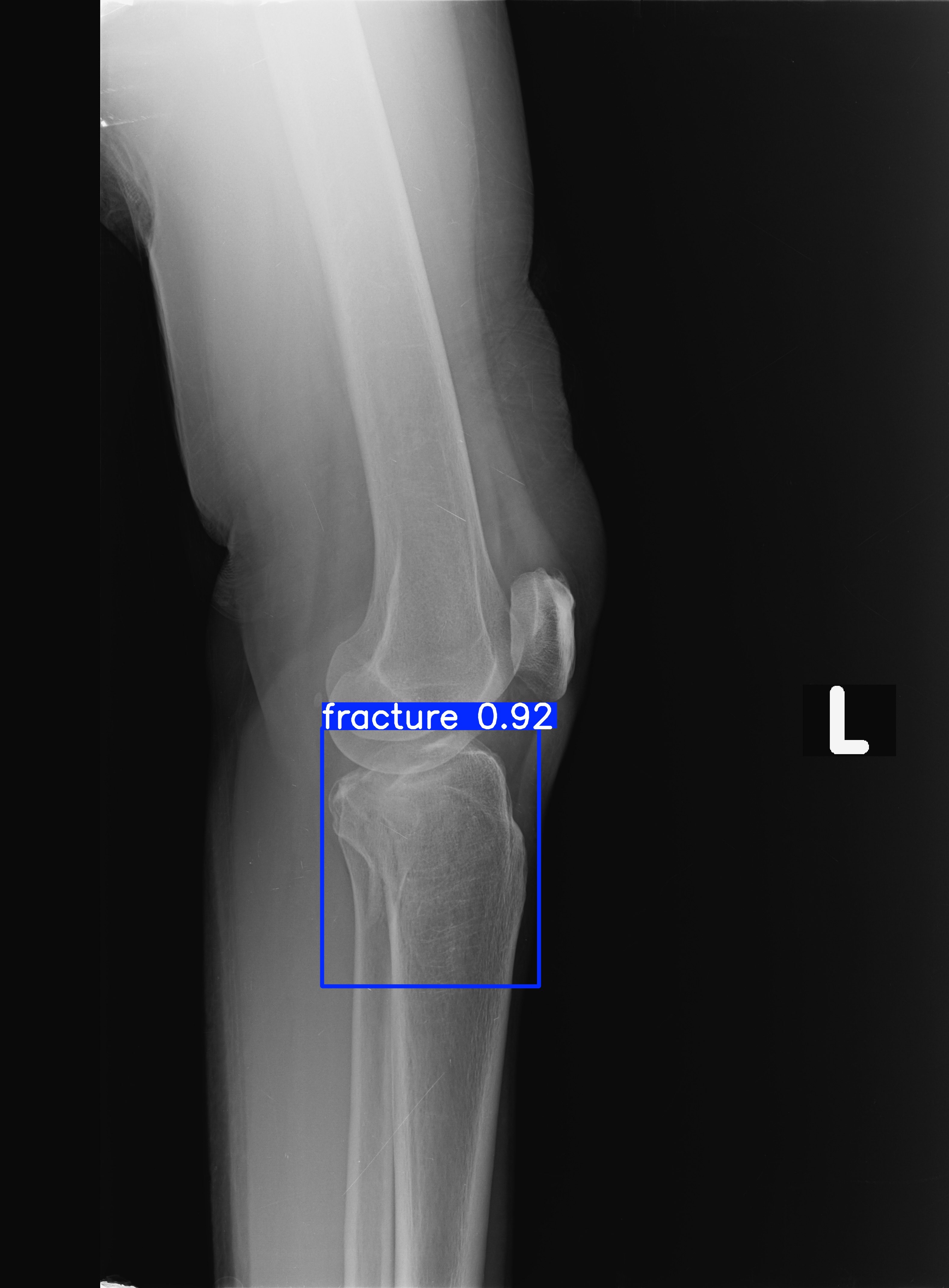 fracture_1-2.jpg