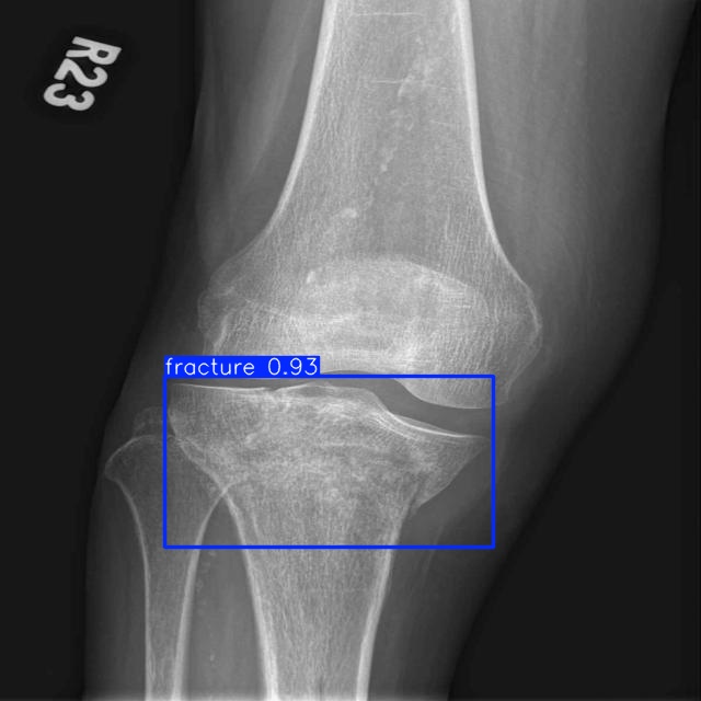 fracture_1_1_1_1_jpg.rf.6c7df134933b87211638730b557fd4c7.jpg