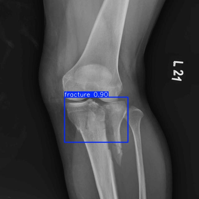 fracture_1_1_1_1_jpg.rf.db02ad512bd2cc0fe85b29eec7c6c198.jpg