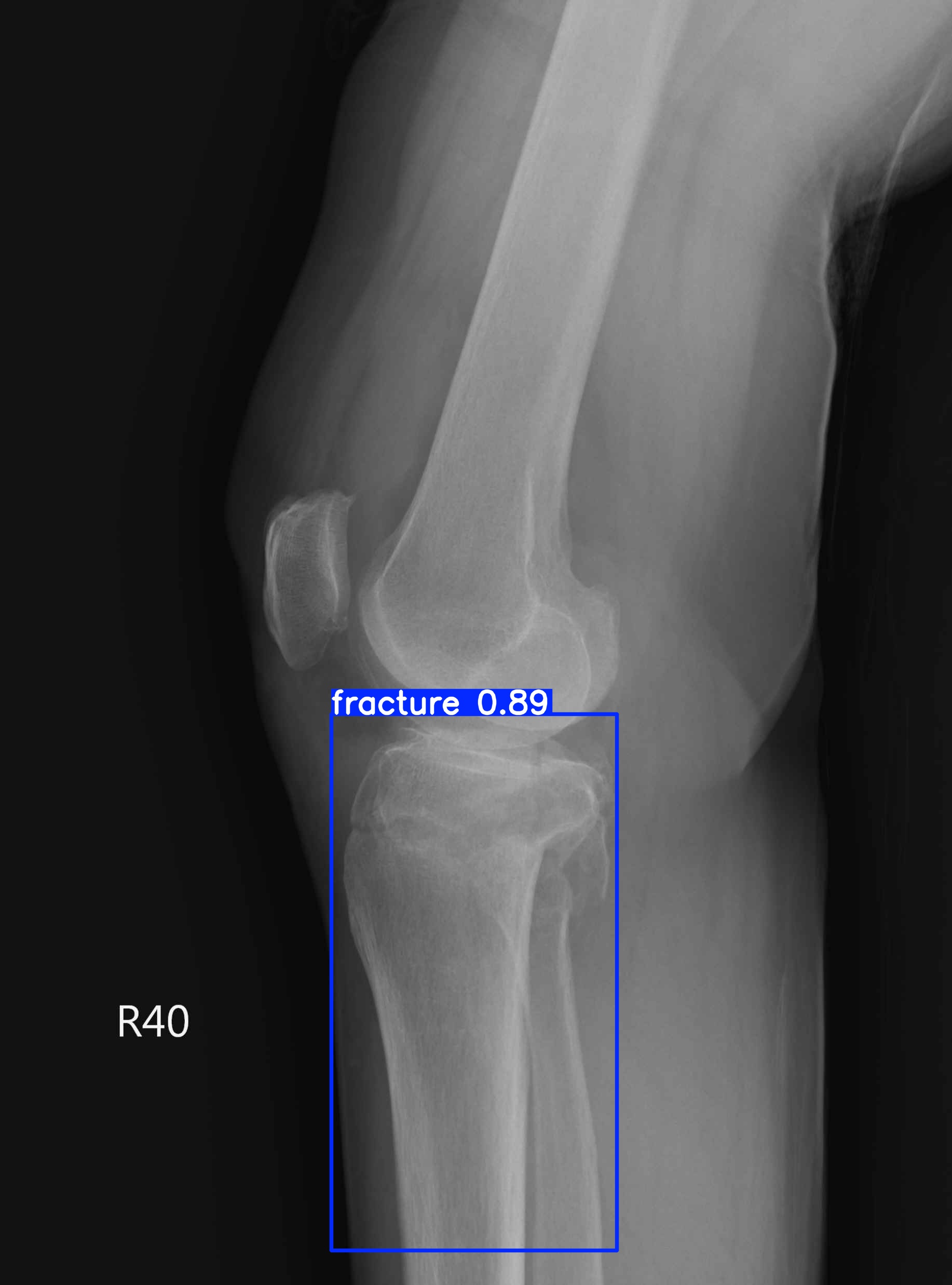 fracture_2. 001814547G_1_2_1_2.jpg