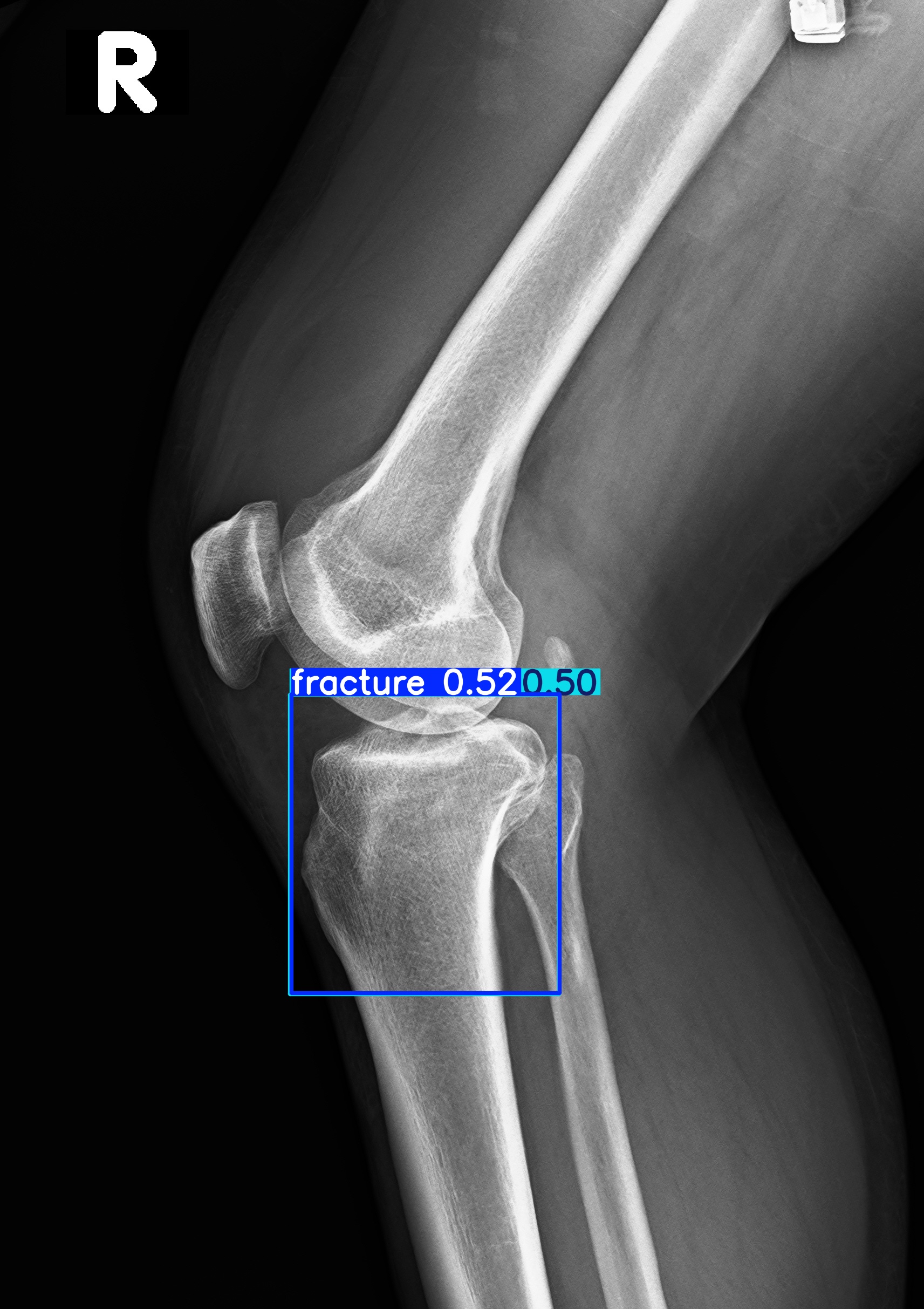 fracture_2.jpg