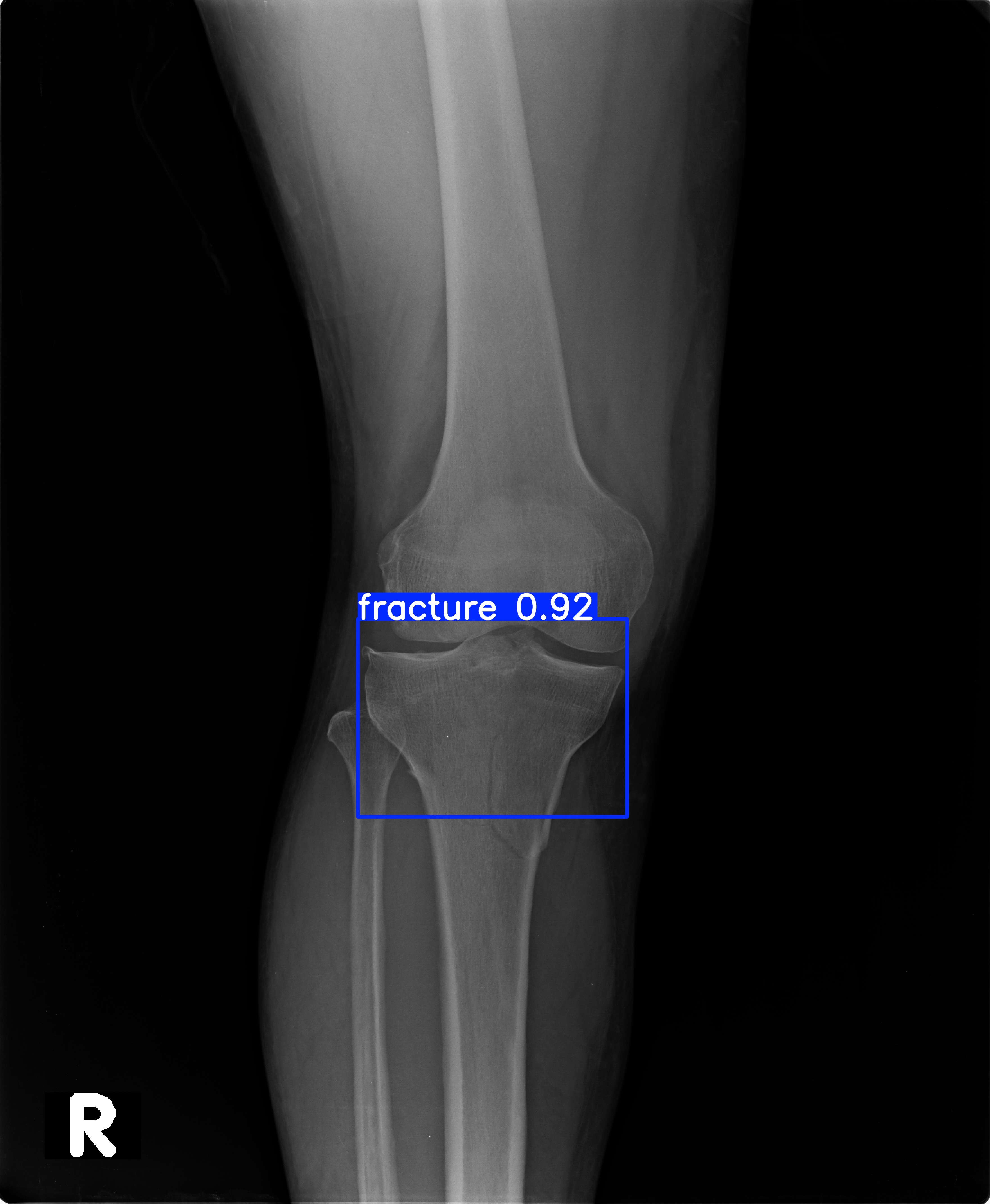 fracture_ap_2-1.jpg
