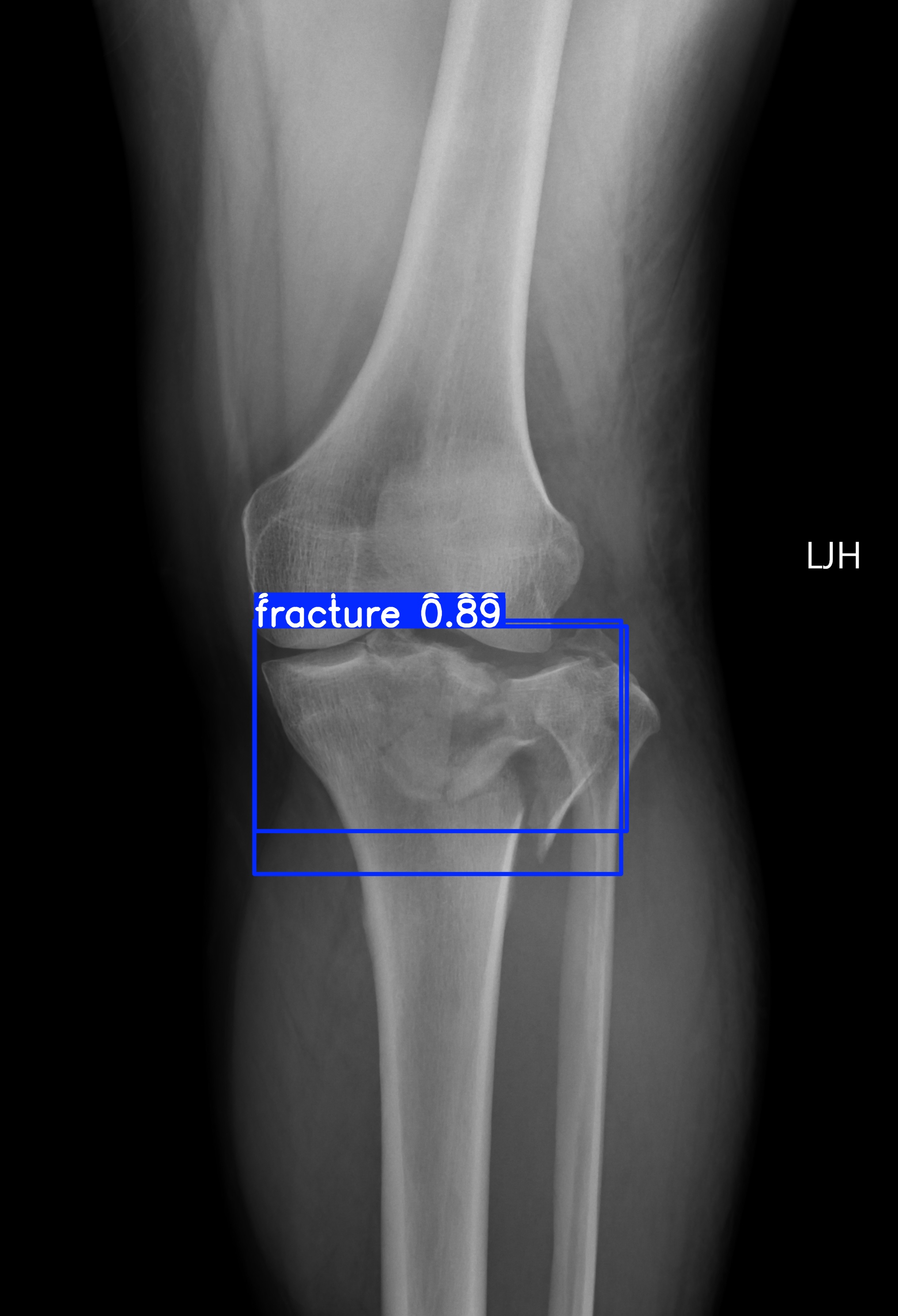 fracture_fracture_001087162C.jpg