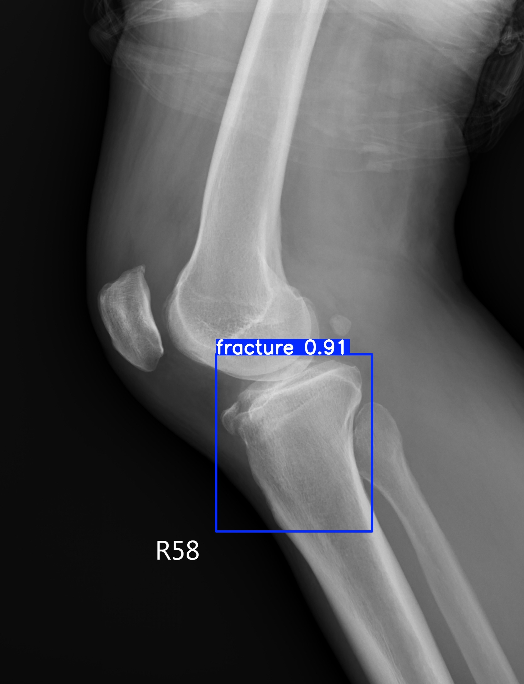 fracture_lateral_002764677B LAT.jpg