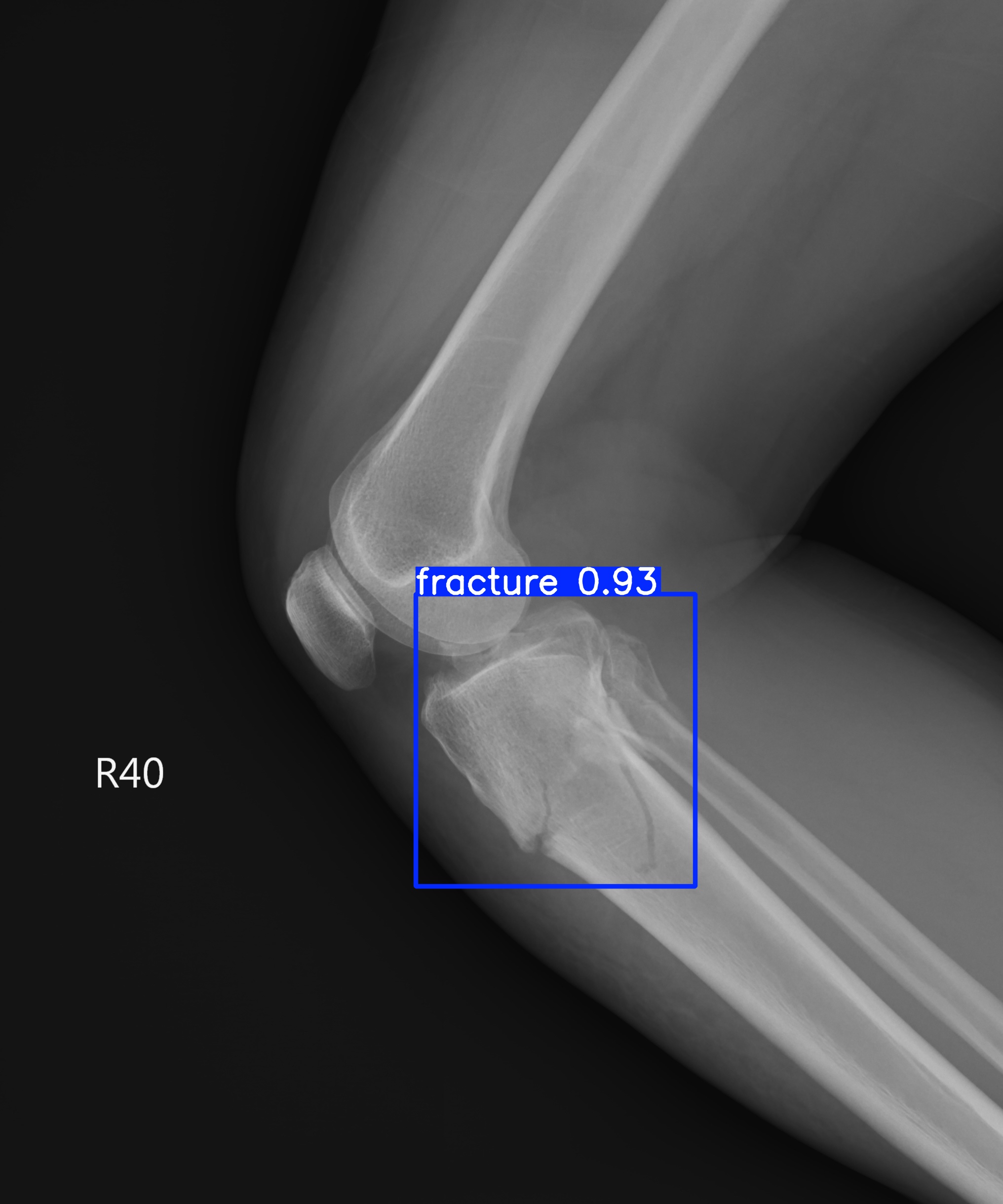 fracture_lateral_2.jpg