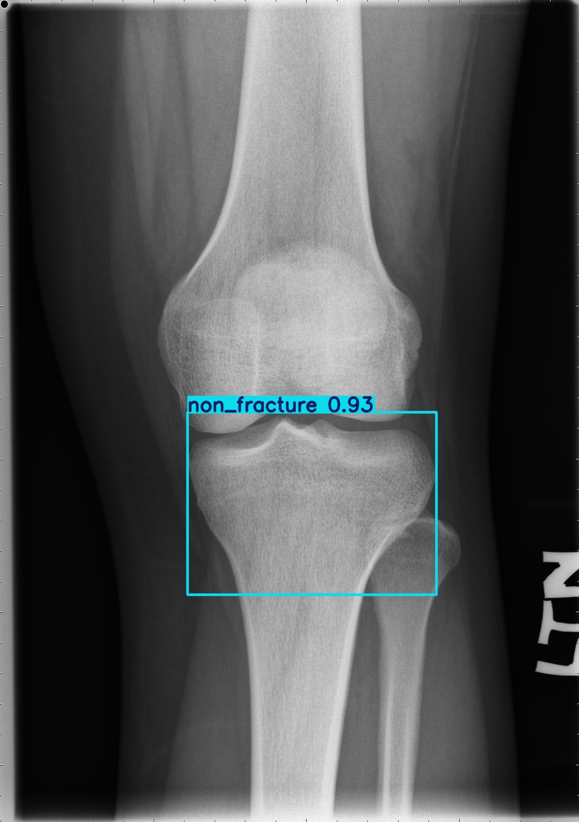 non_fracture_000533807I.jpg