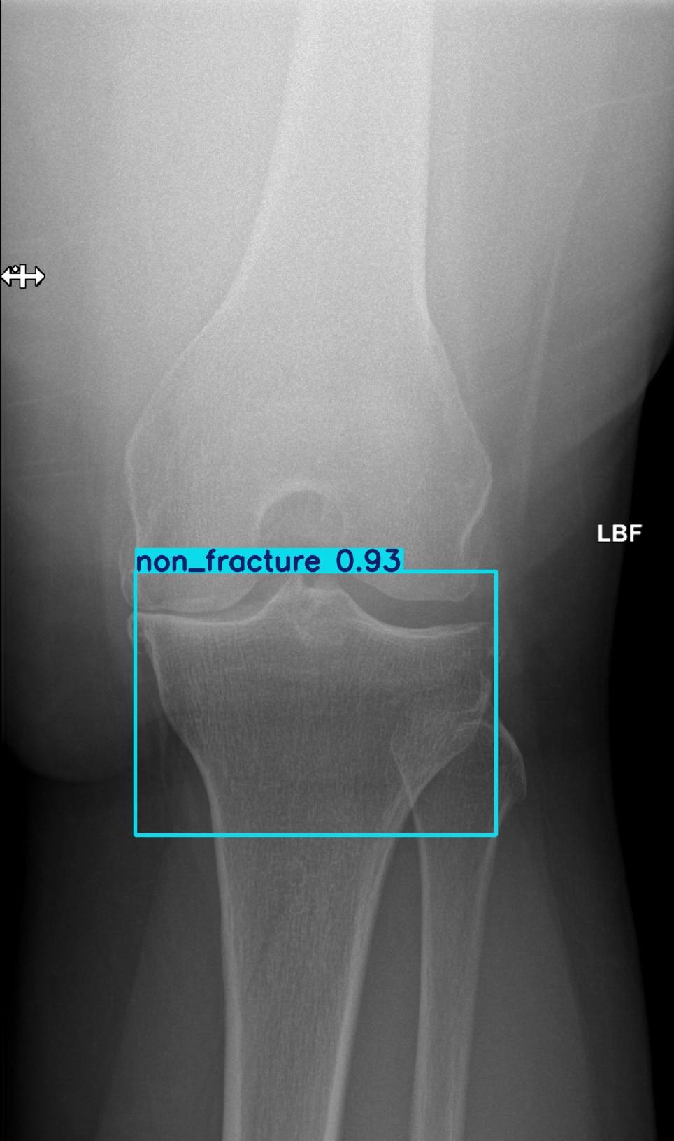 non_fracture_000882870E 2.jpg